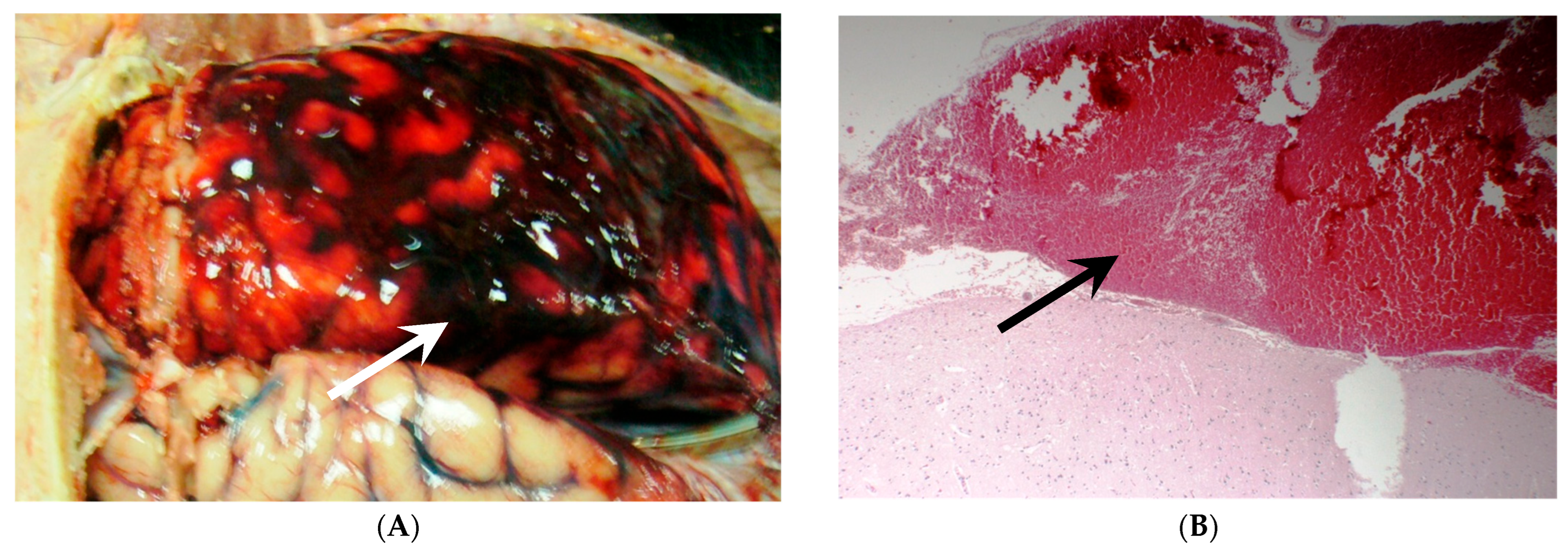 The subarachnoid hemorrhage (SAH) stages. The yellow arrows