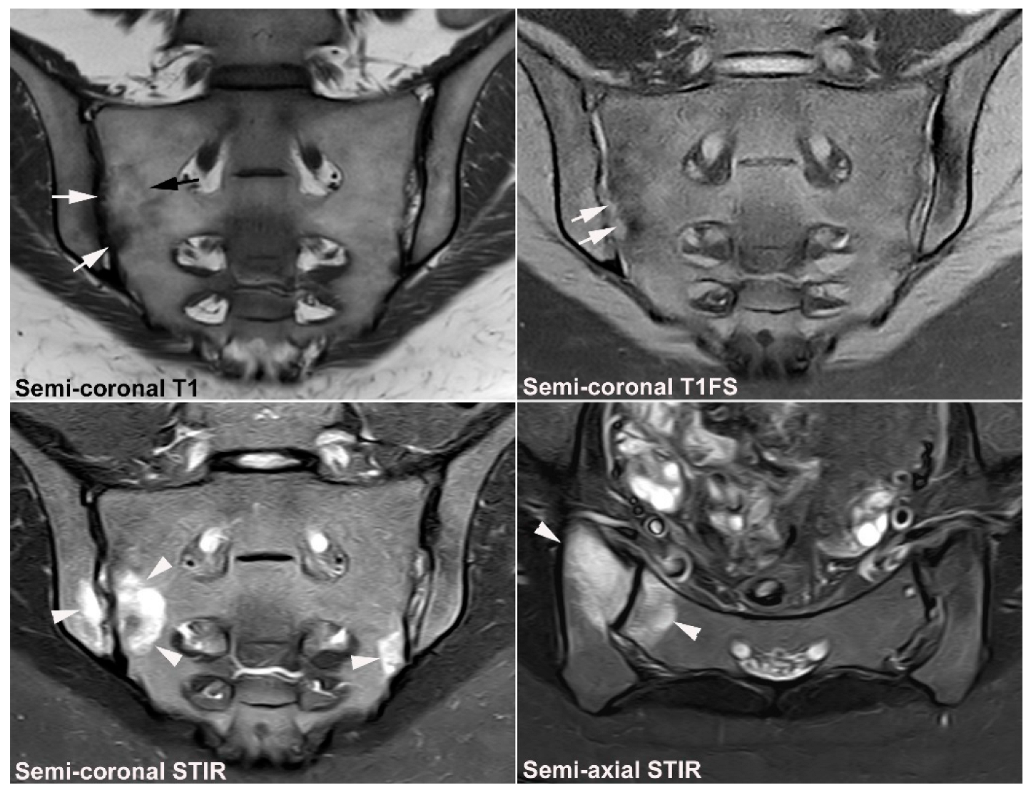 Free Full-Text | Diagnostics of Sacroiliac Joint Differentials to Axial Spondyloarthritis Changes by Magnetic Resonance