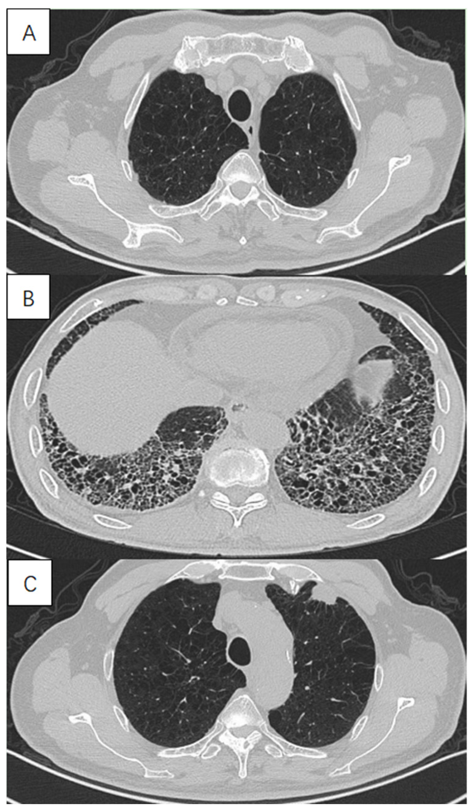 The Impact of Lung Cancer in Patients with Combined