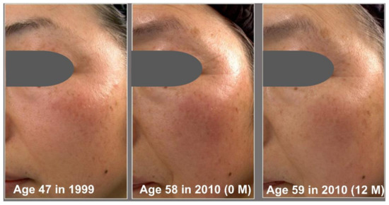 Significant Reversal of Facial Wrinkle, Pigmented Spot and Roughness by ...