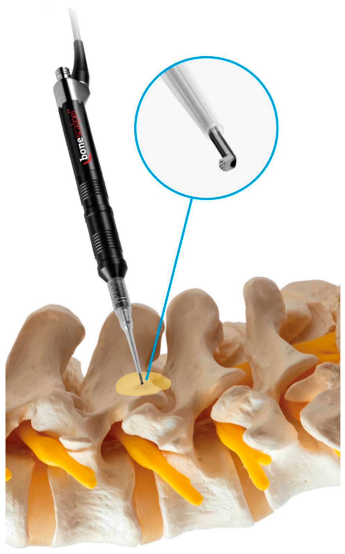 JCM Free FullText The Use of Ultrasonic Bone Scalpel (UBS) in
