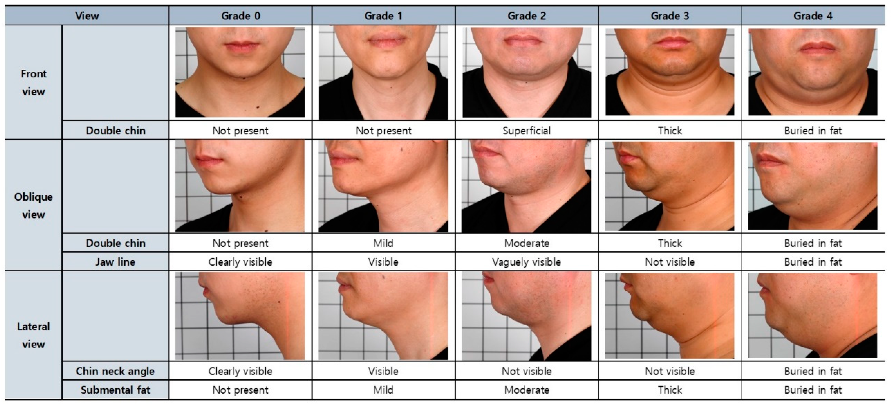 JCM Free FullText The Study of a Validated Assessment Scale for a Localized Submental Fat