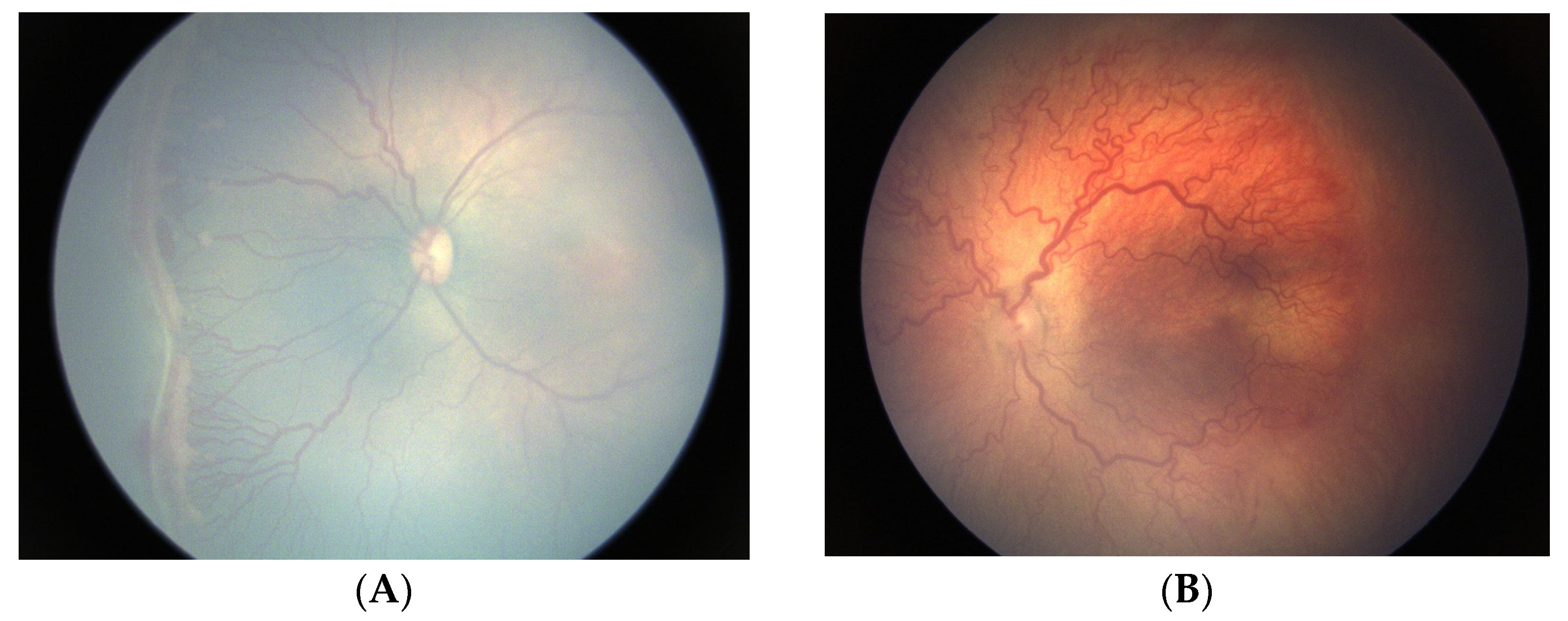 JCM Free Full Text Retinopathy of Prematurity in the 21st