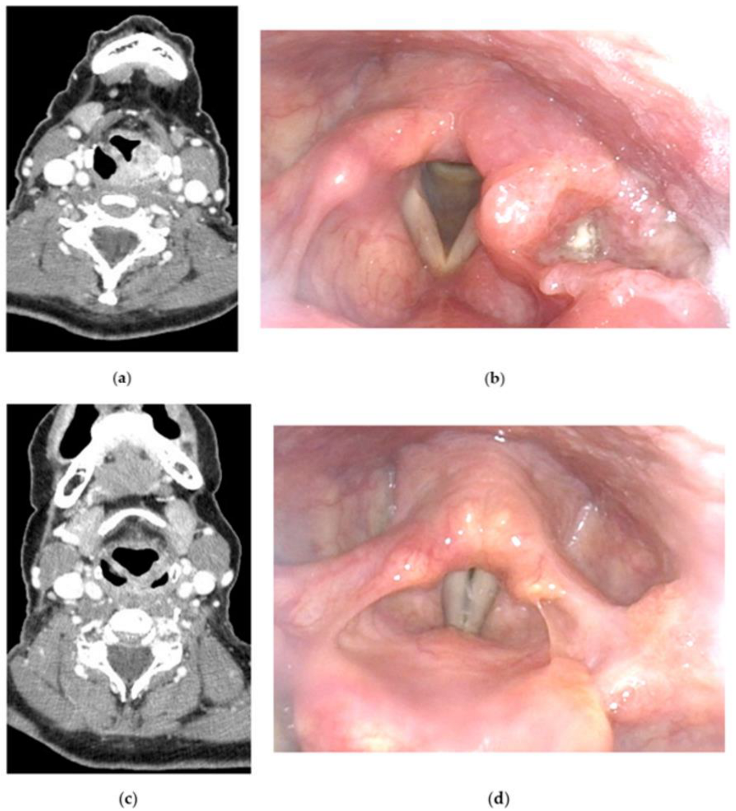 JCM | Free Full-Text | Current Therapeutic Strategies for Patients with  Hypopharyngeal Carcinoma: Oncologic and Functional Outcomes