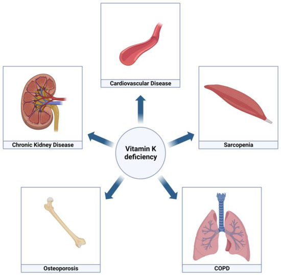 JCM Free FullText The Pleiotropic Role of Vitamin K in Multimorbidity of Chronic