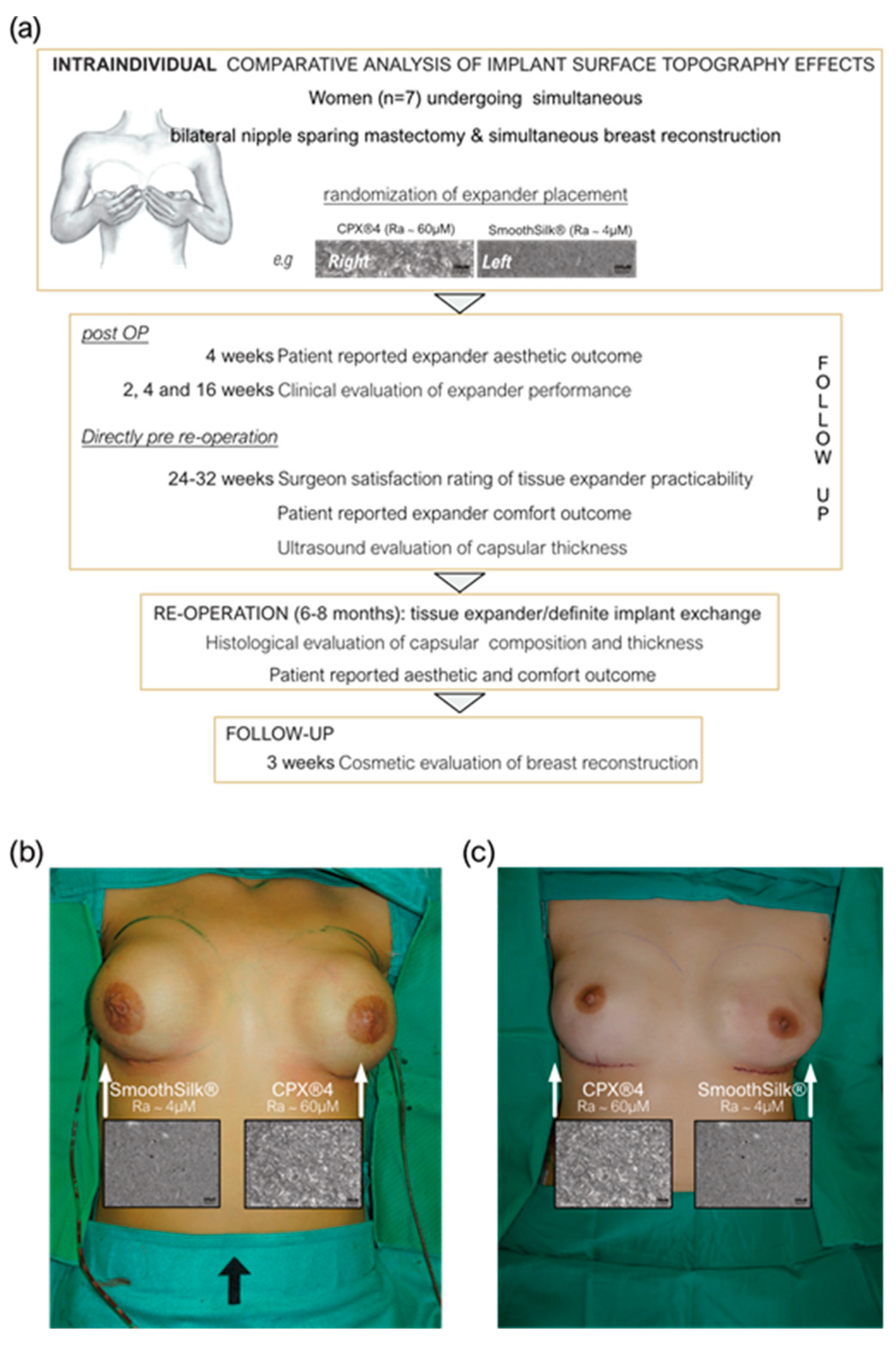 A) Clinical presentation of breast enlargement with periimplant