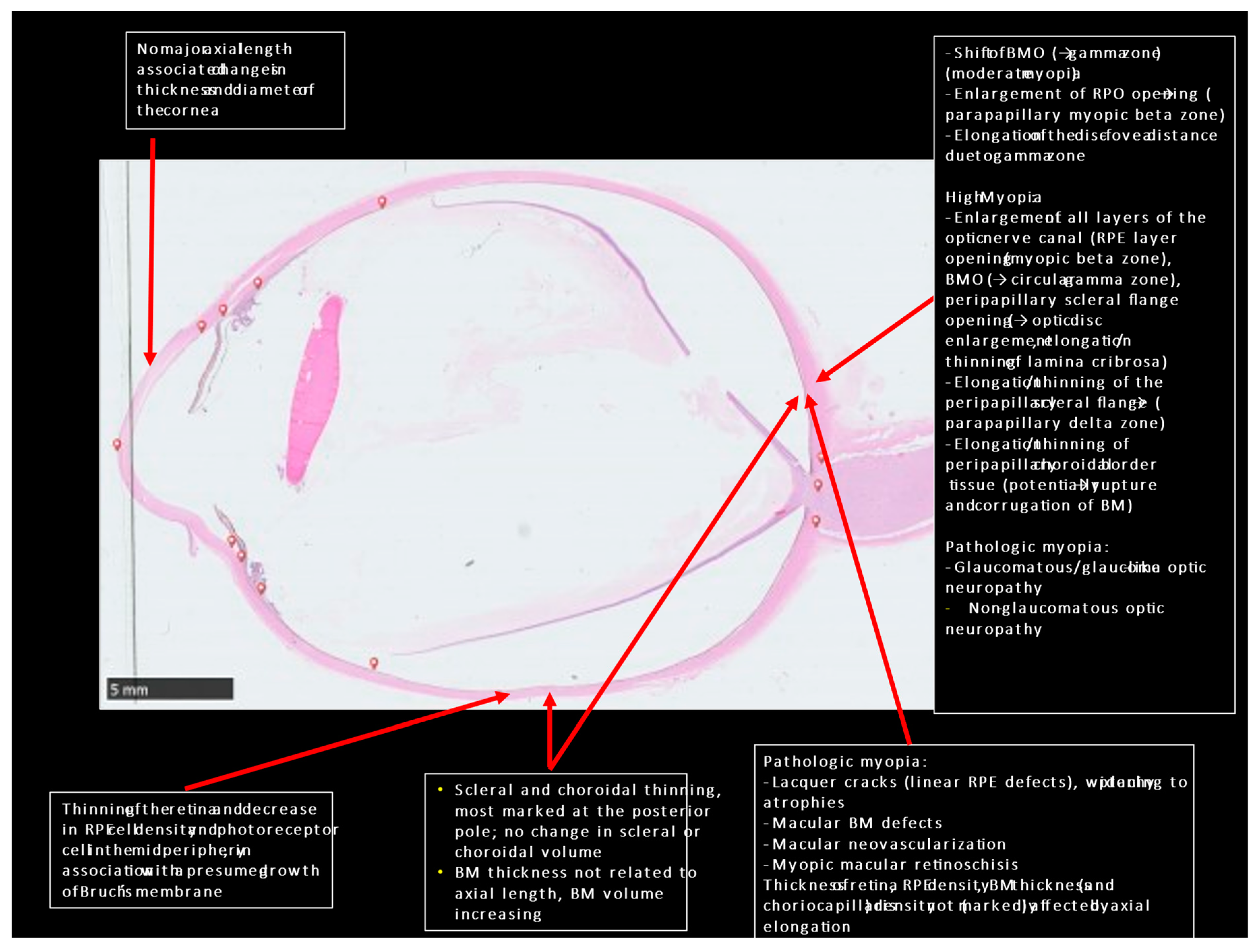 Anatomic Peculiarities Associated with Axial Elongation of
