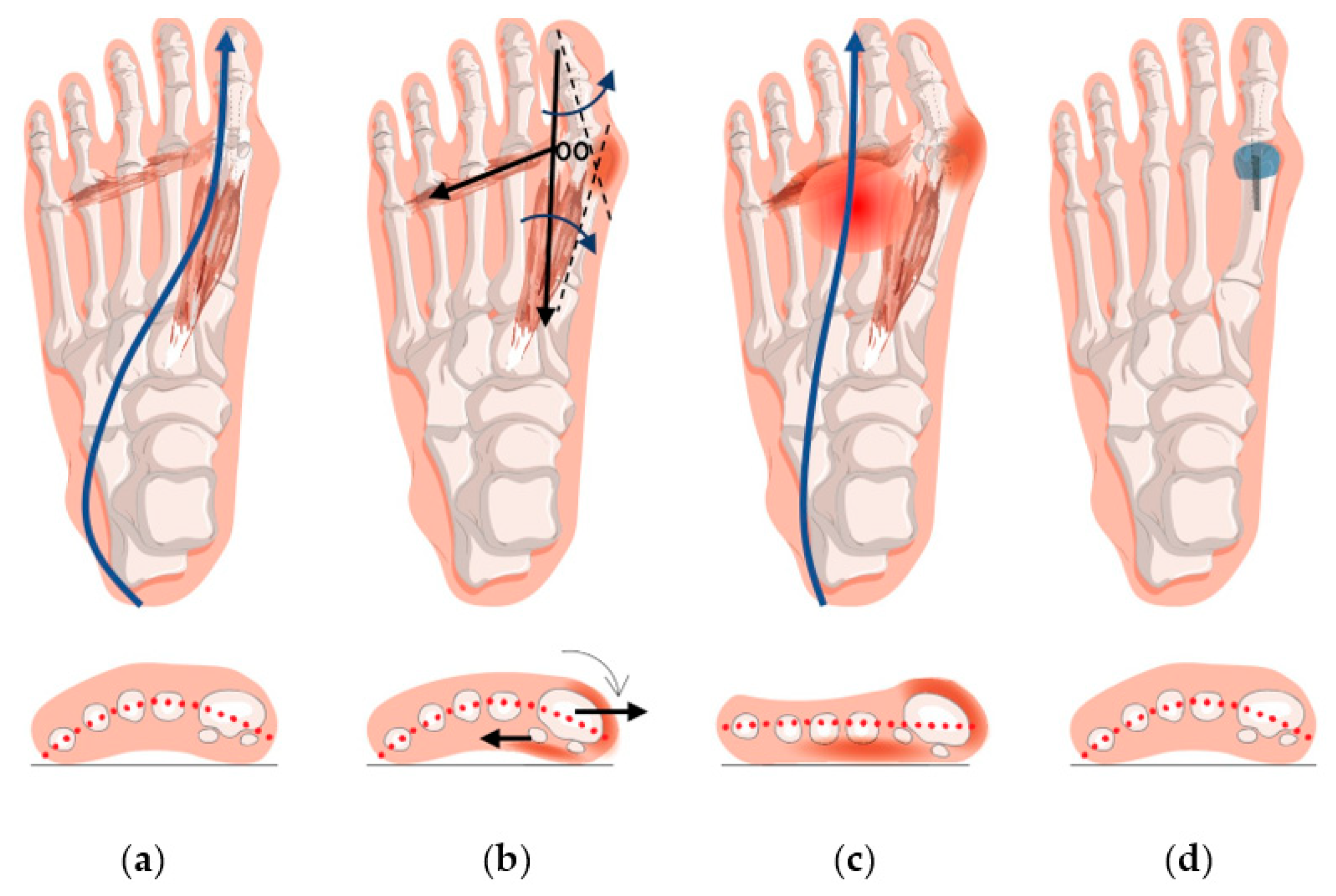 JCM Free Full-Text Forefoot Function after Hallux Valgus Surgery A Systematic Review and Meta-Analysis on Plantar Load Measurement photo pic