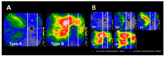 Sex- and Age-Dependent Wide-Field Choroidal Thickness Differences