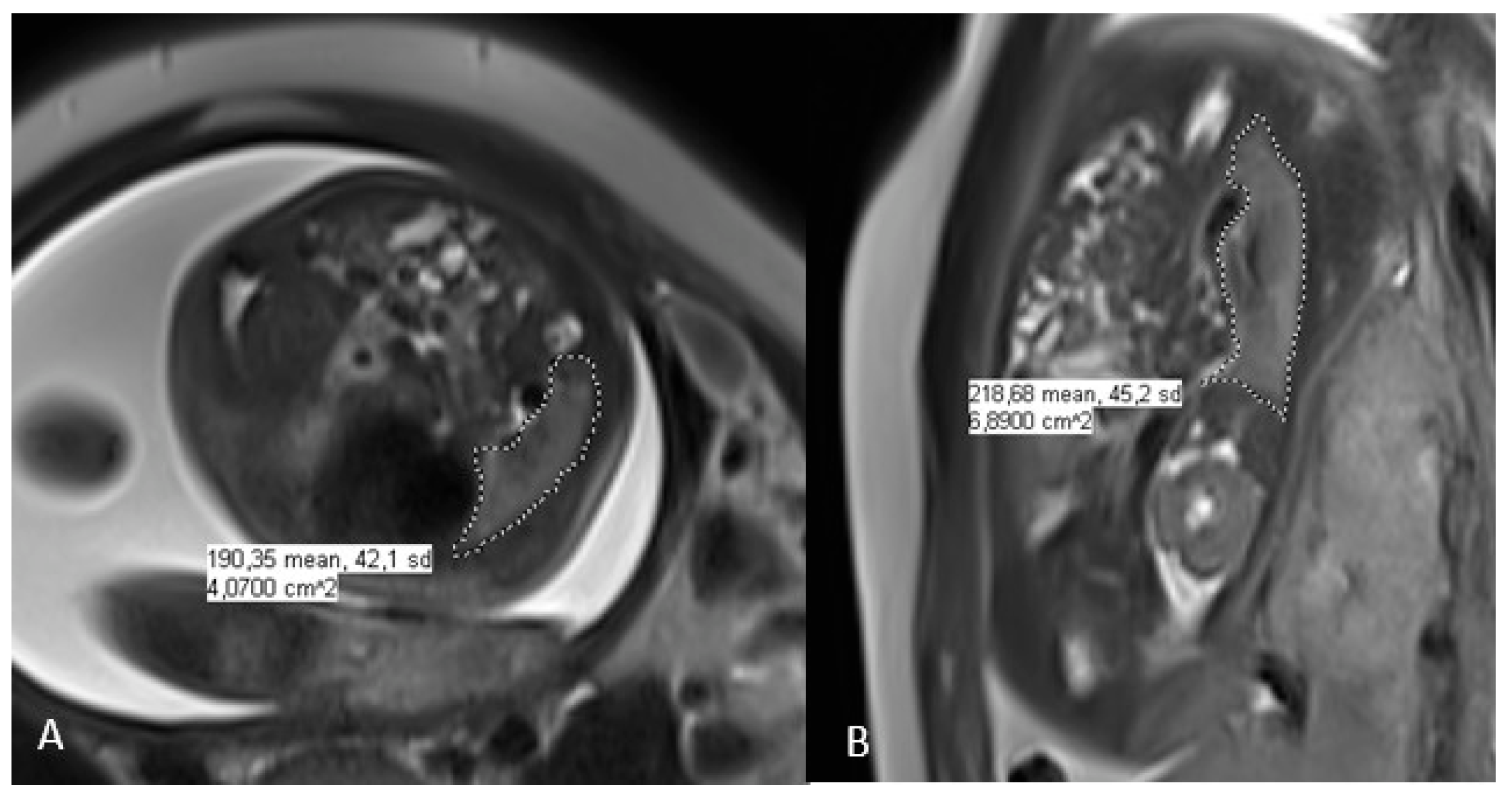 JCM Free FullText Fetal Lung Volume Appears to Predict Respiratory