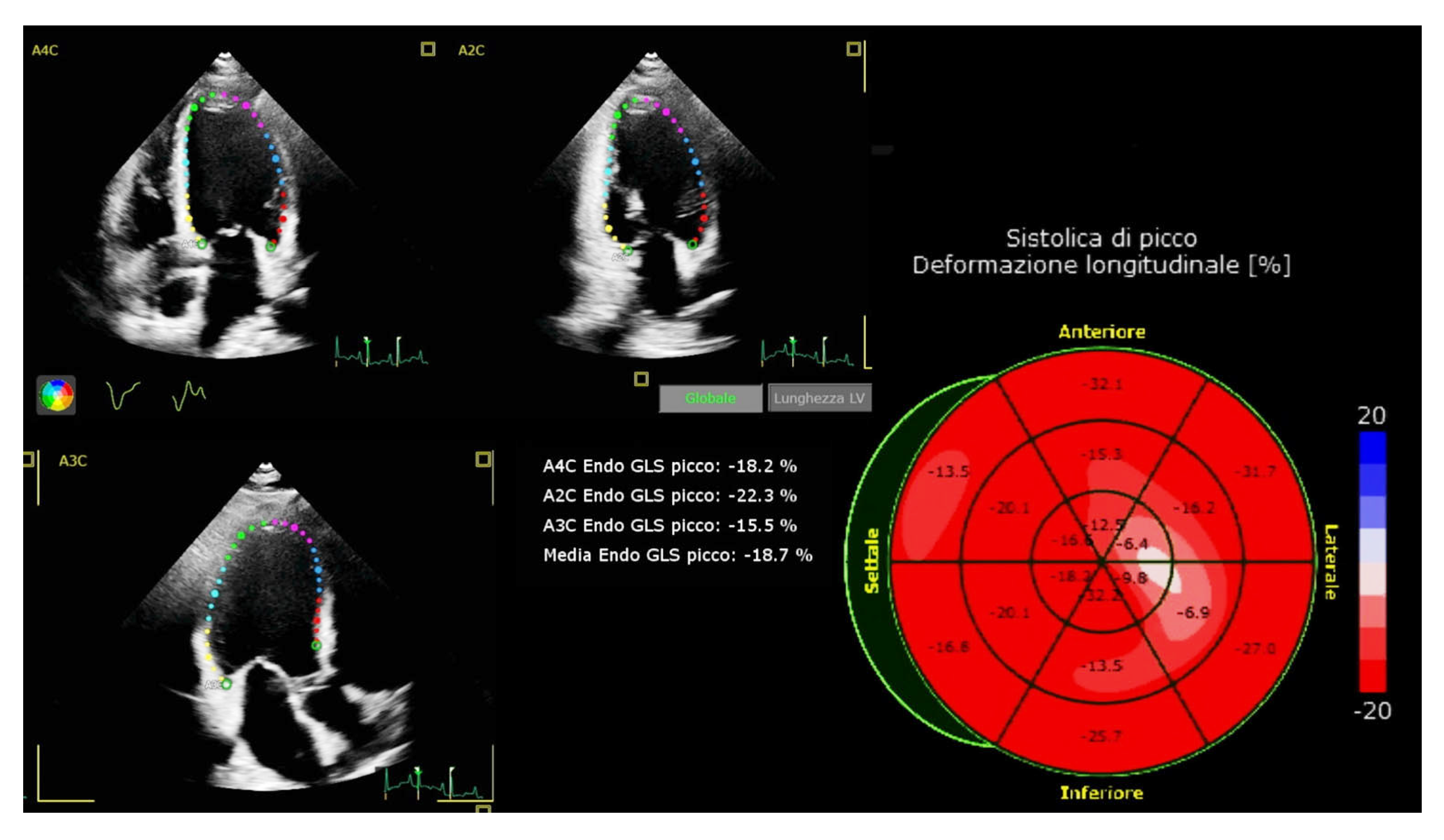 Lv Strain Echo Normal Values