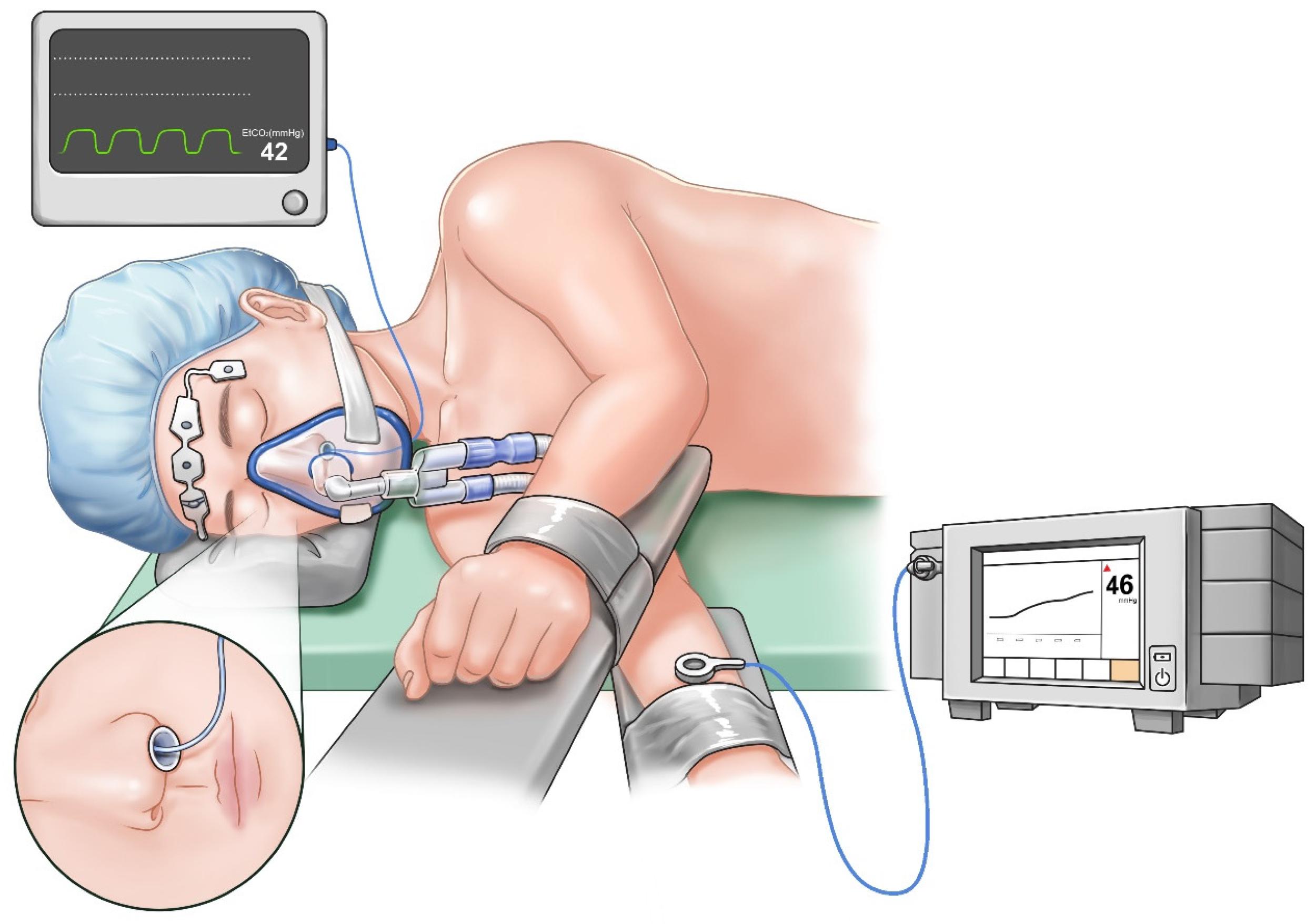 JCM Free Full-Text Transcutaneous Carbon Dioxide Monitoring More Accurately Detects Hypercapnia than End-Tidal Carbon Dioxide Monitoring during Non-Intubated Video-Assisted Thoracic Surgery A Retrospective Cohort Study pic photo