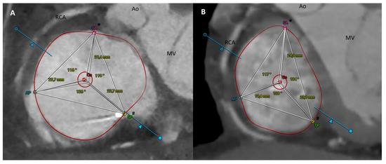 Tricuspid Valve Geometrical Changes in Patients with Functional ...