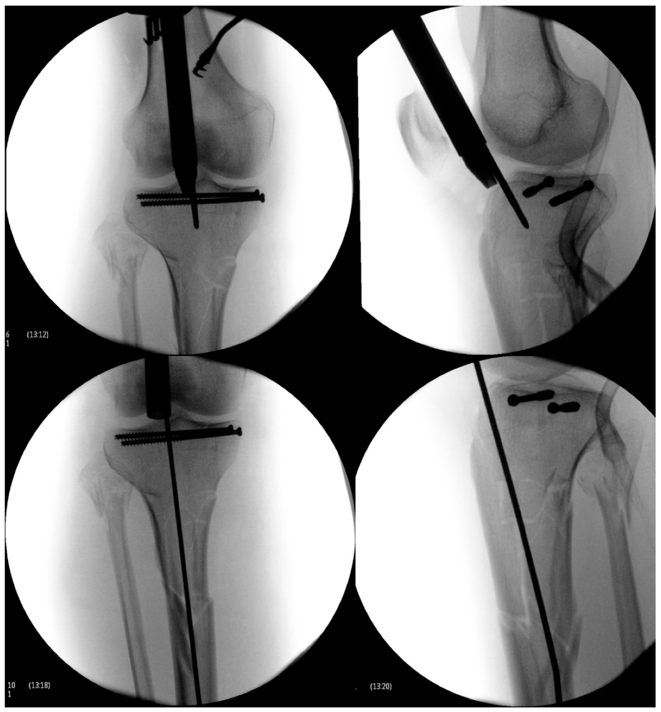 OIC Launches Intramedullary Tibial Nail - Medical Design and Outsourcing