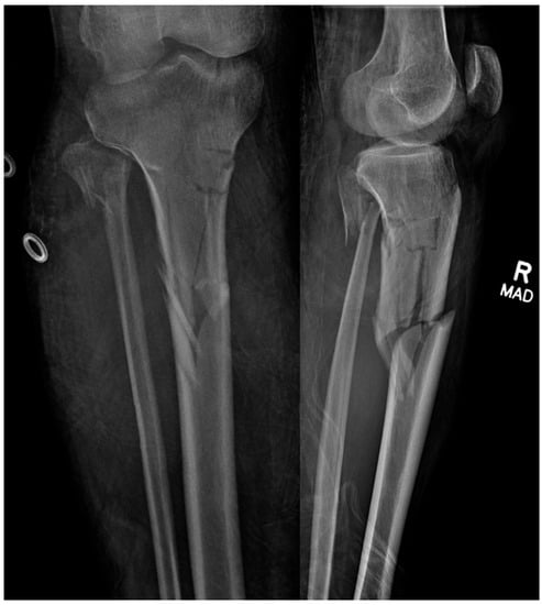 LCP as supracutaneous plate vs IMLN tibia for open grade 1 and Ⅱ distal  tibial fractures. A comparison study (RCT) on Functional outcome between a  conventional method and a Novel technique |
