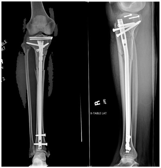 PDF] Surgical management of open tibial shaft fractures in adults by reamed  versus unreamed intramedullary interlocking nailing: A comparative study |  Semantic Scholar