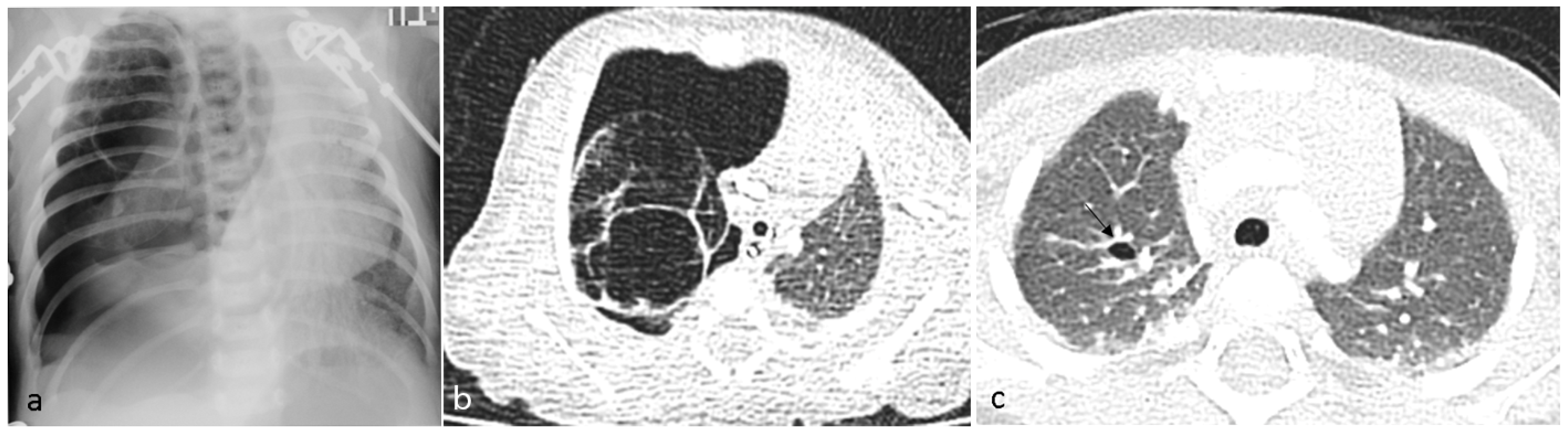 JCM Free FullText Challenges in DICER1Associated Lung Disease