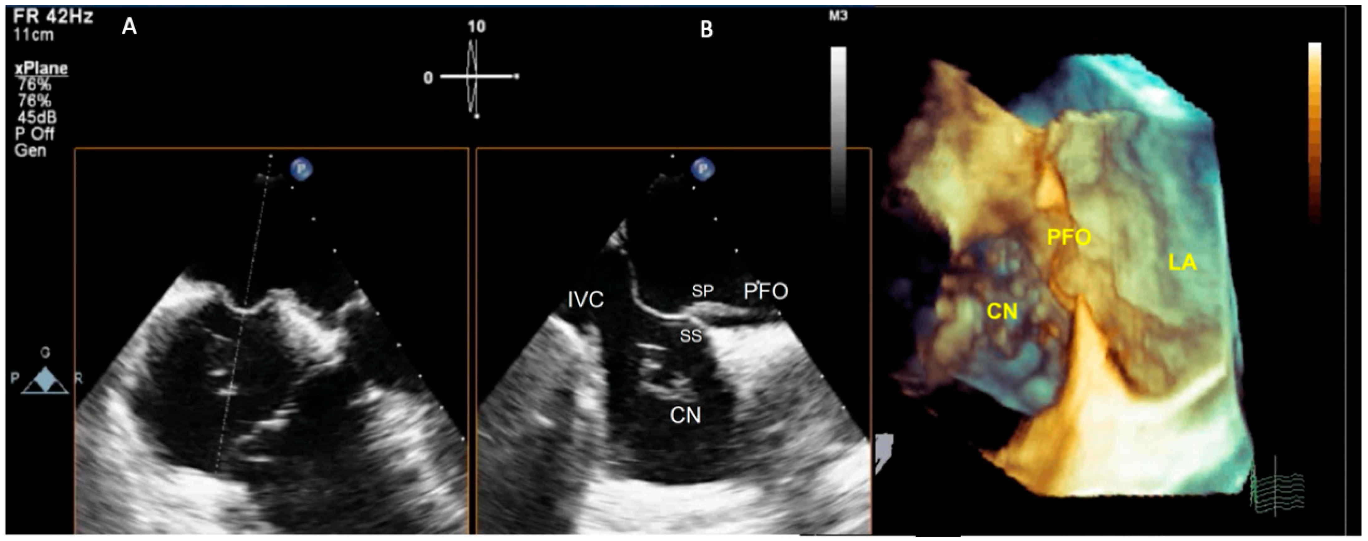 JCM Free FullText Patent Foramen Ovale and Cryptogenic Stroke