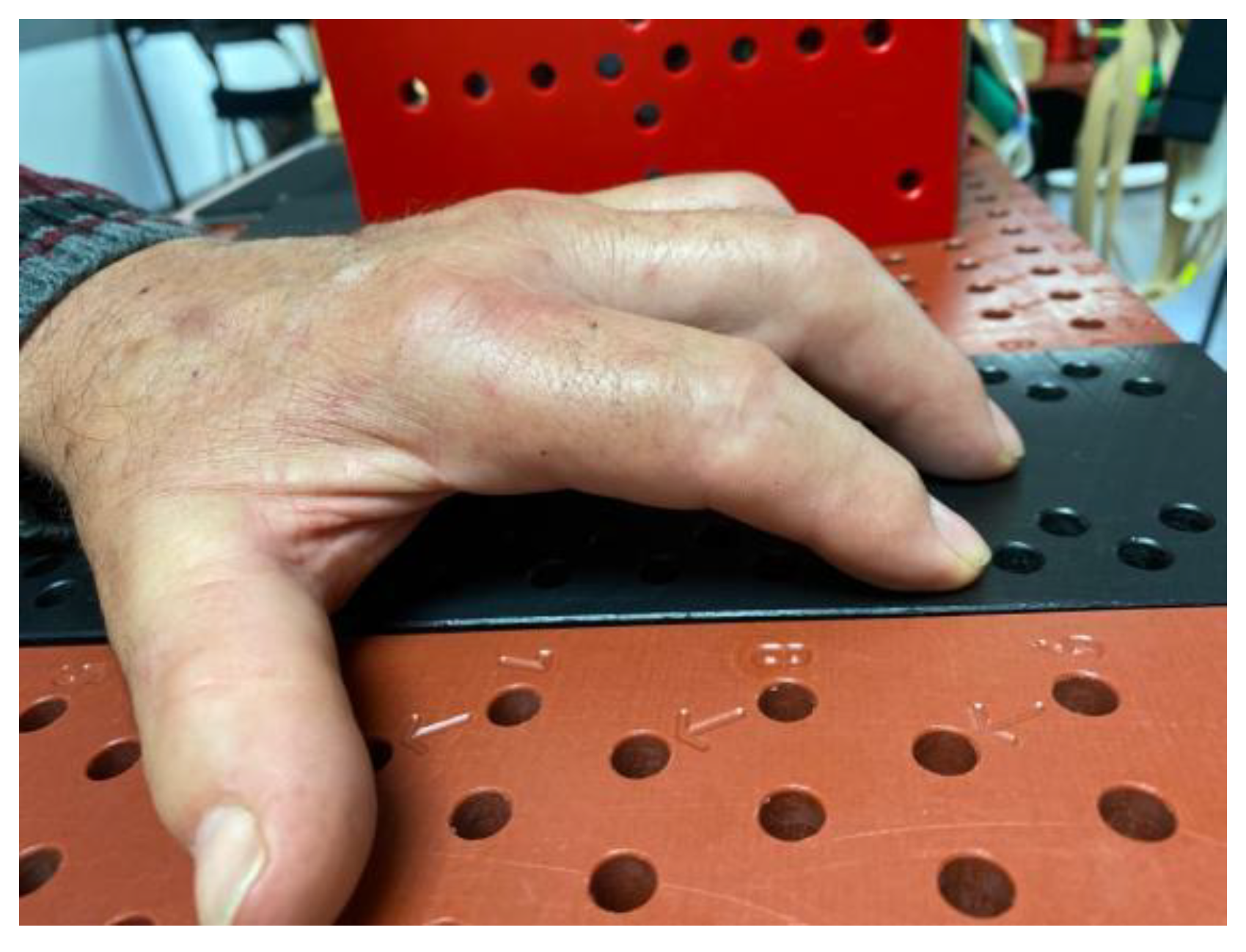 Proximal Interphalangeal Joint Flexion Contracture Di vrogue.co