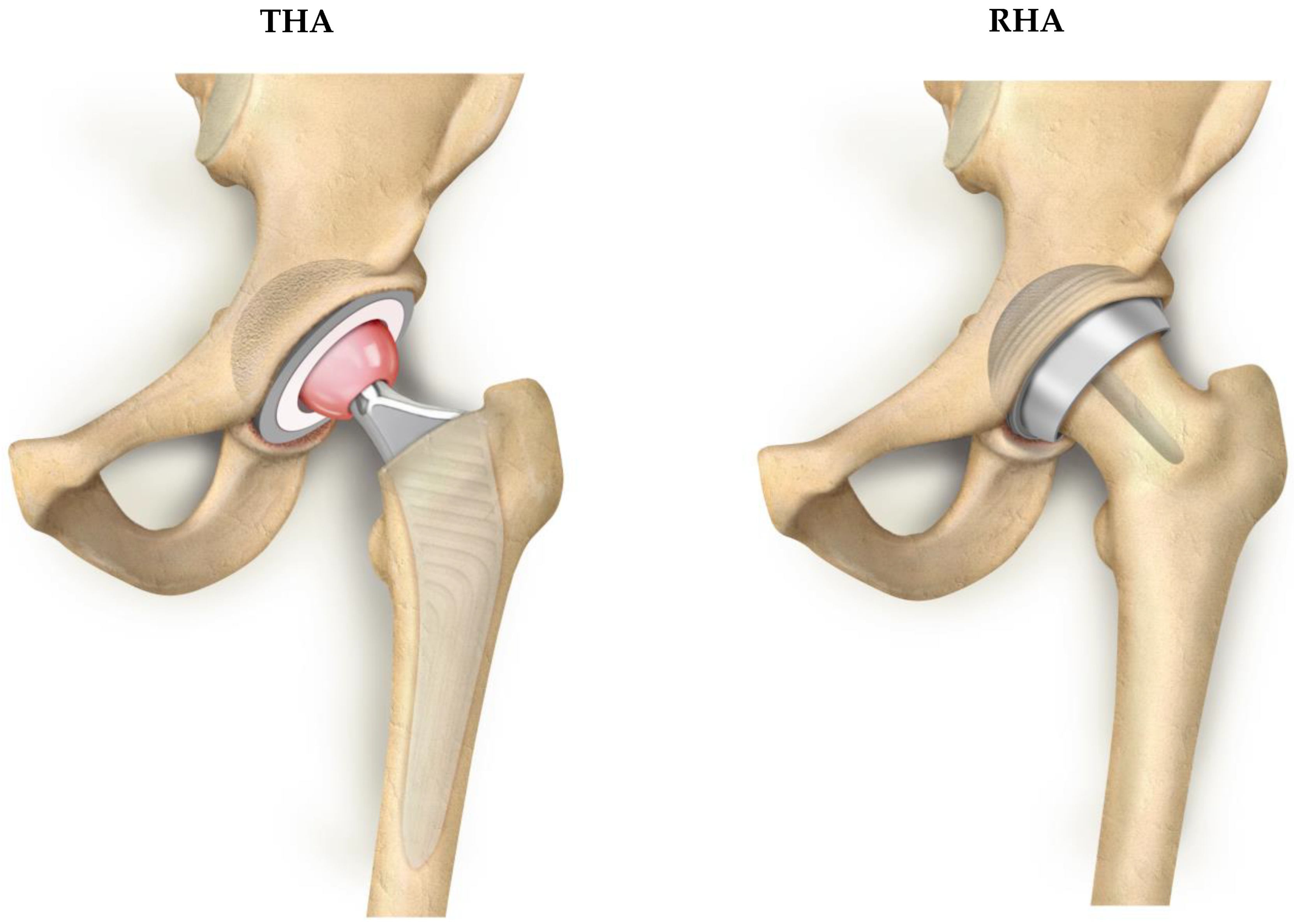 Resurfacing Hip Arthroplasty Is a Safe and Effective Alternative 