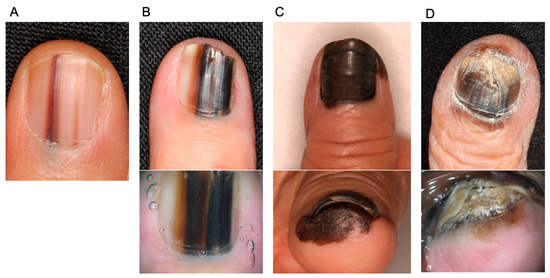 Figure 15 from Longitudinal melanonychia in childhood. | Semantic Scholar