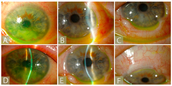 JCM | Free Full-Text | Corneal Neurotization—Indications, Surgical ...
