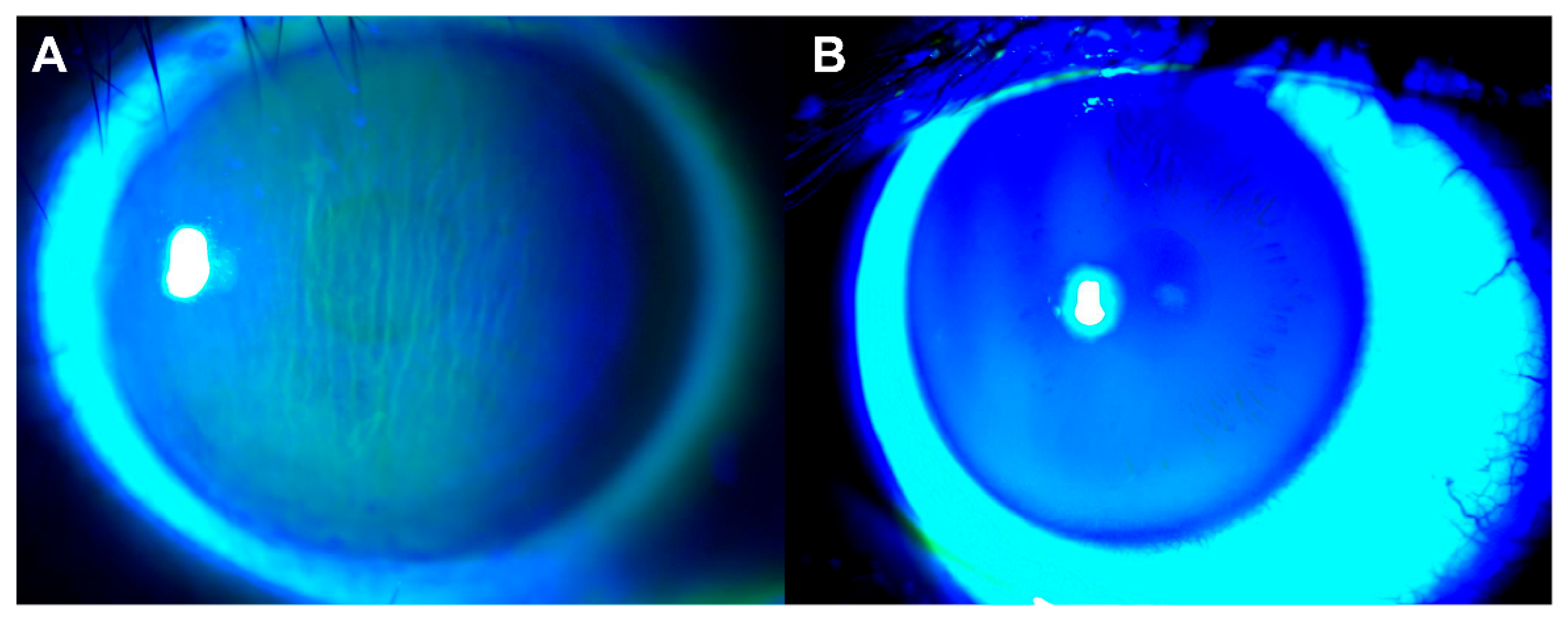 JCM | Free Full-Text | Clinical Significance of Corneal Striae in Thyroid  Associated Orbitopathy