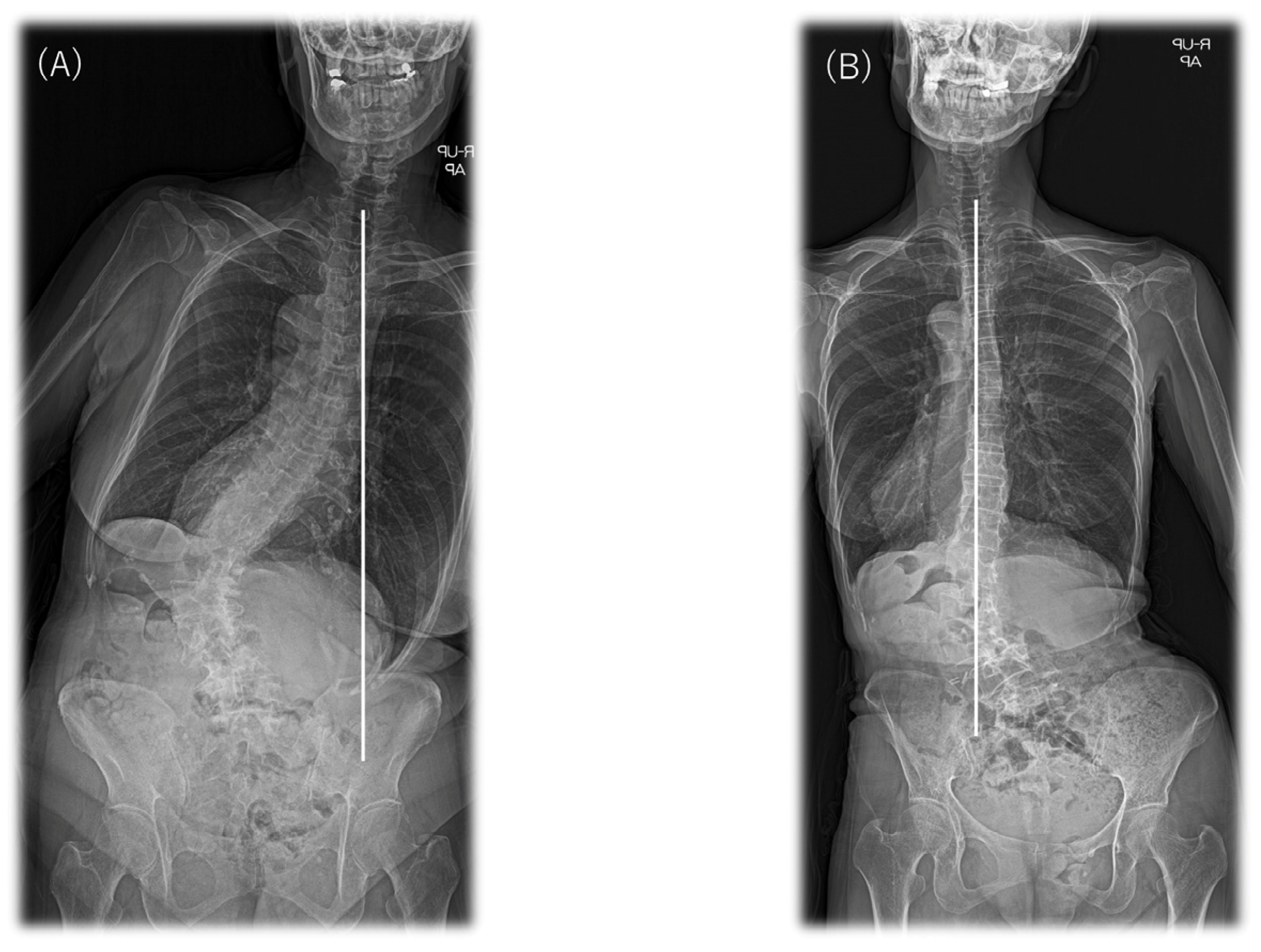 Spinal Fusion Before And After