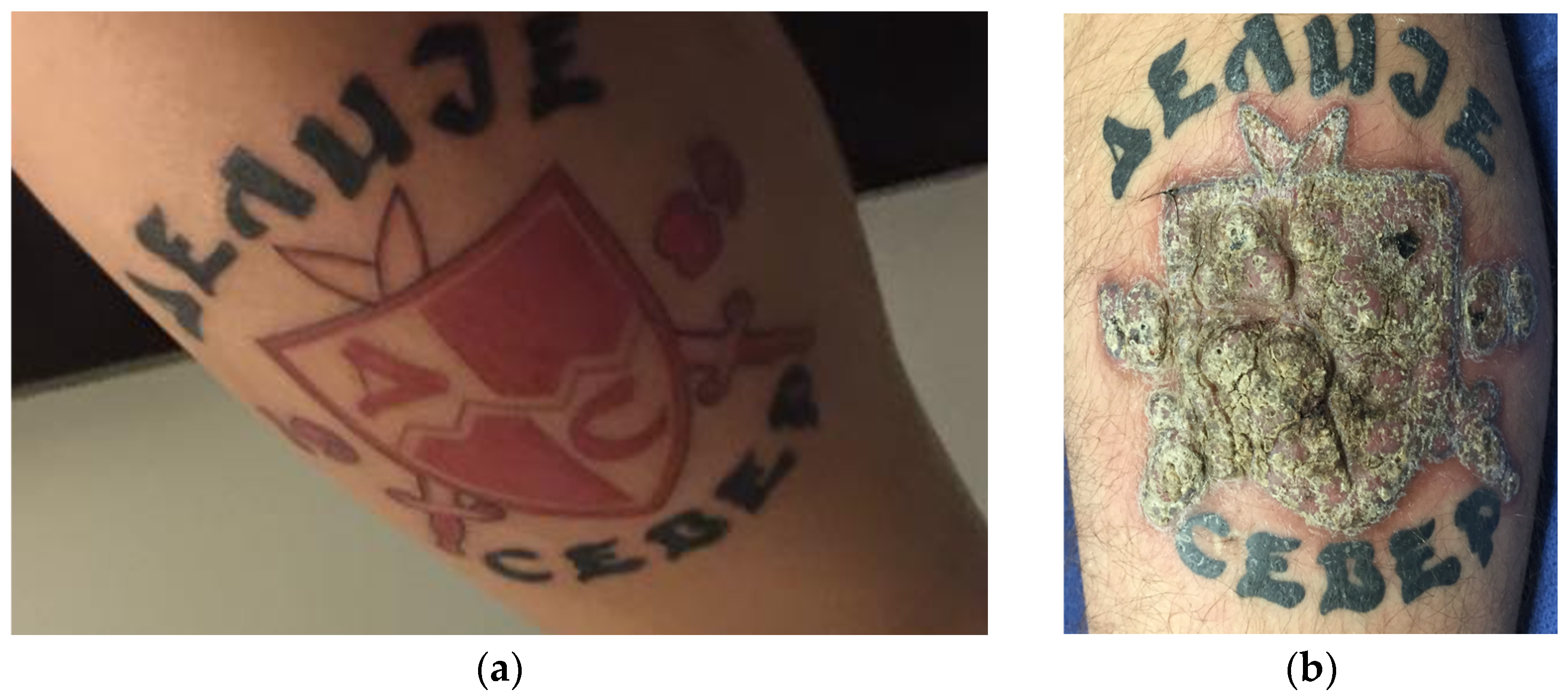 Tattoo hypersensitivity reaction. Exuberant verrucous nodules