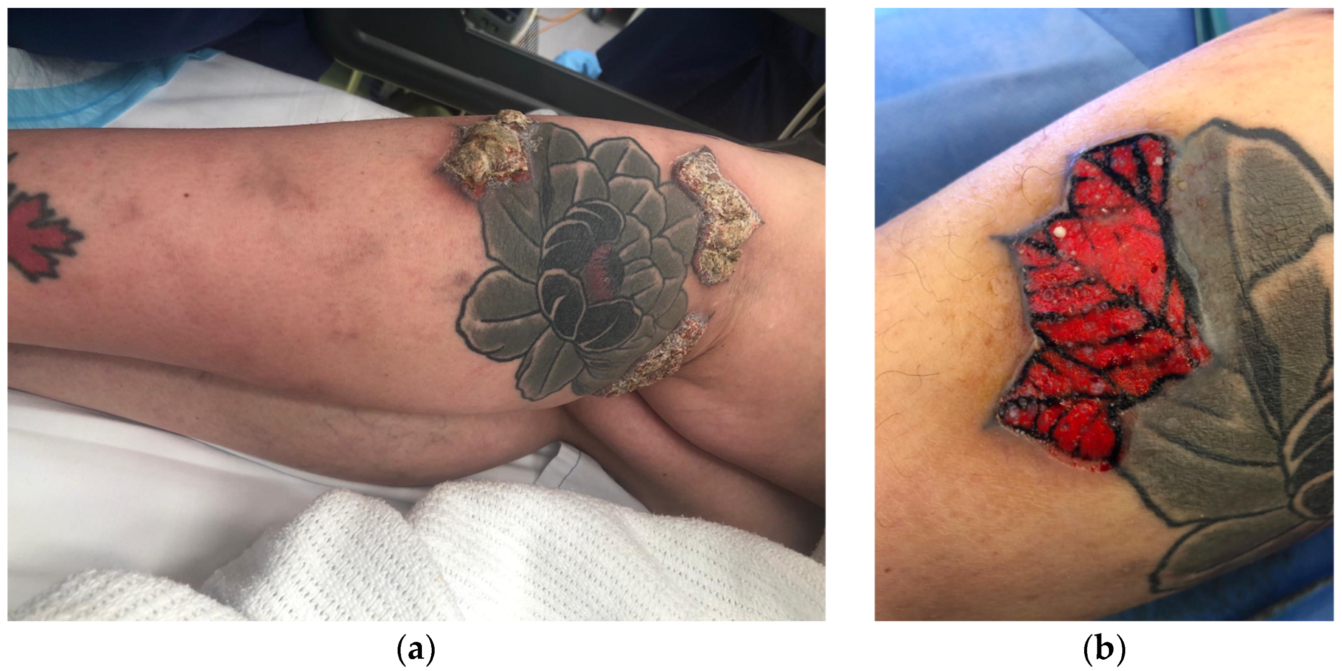 JCM  Free FullText  Pathogenesis Diagnosis and Management of Squamous  Cell Carcinoma and Pseudoepithelial Hyperplasia Secondary to Red Ink Tattoo  A Case Series and Review