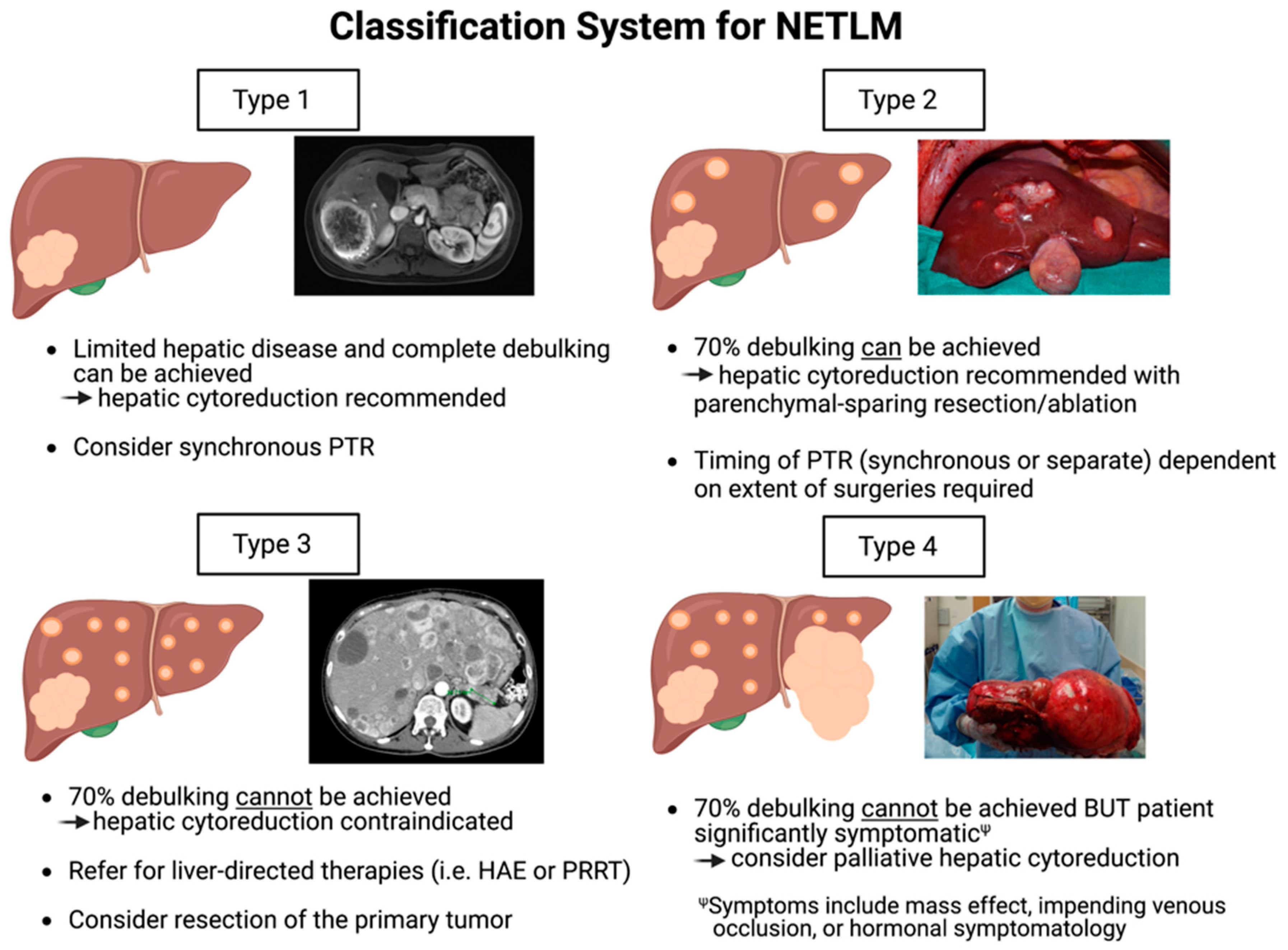 Stage 4 Neuroendocrine Pancreatic Cancer Life Expectancy Defining a New Classification System for the Surgical Management of