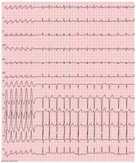 Arrhythmic Manifestations of Cardiac Amyloidosis: Challenges in Risk ...