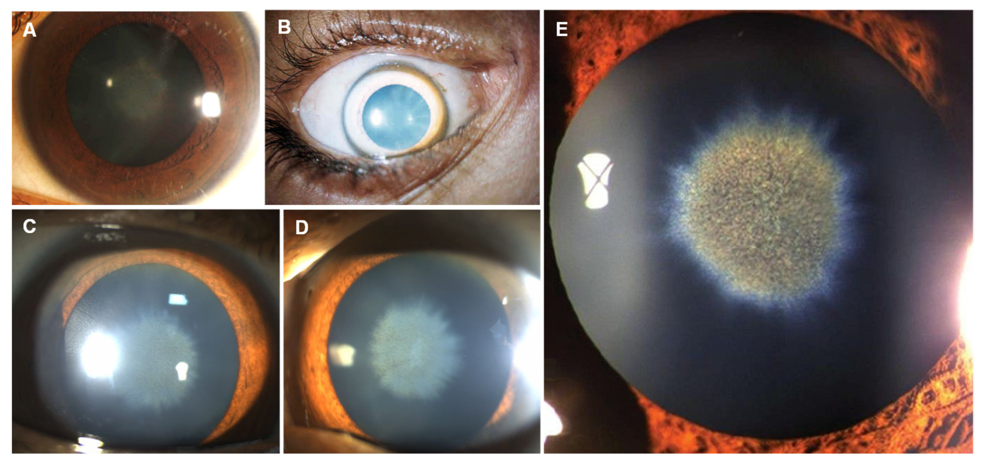 Ocular manifestations of liver disease in children: Clinical aspects and  implications