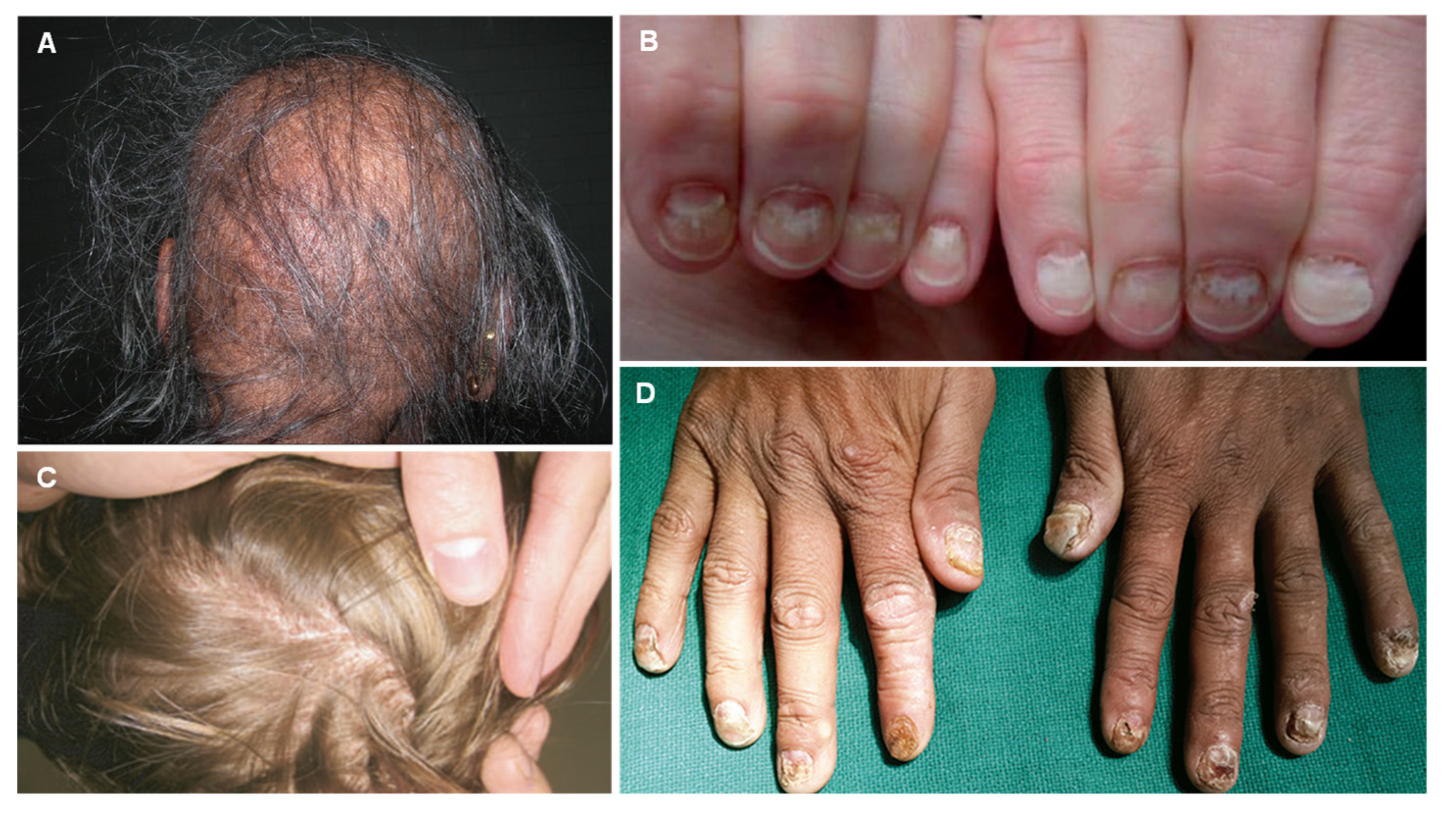 Arsenic poisoning and Mees' lines. | Semantic Scholar