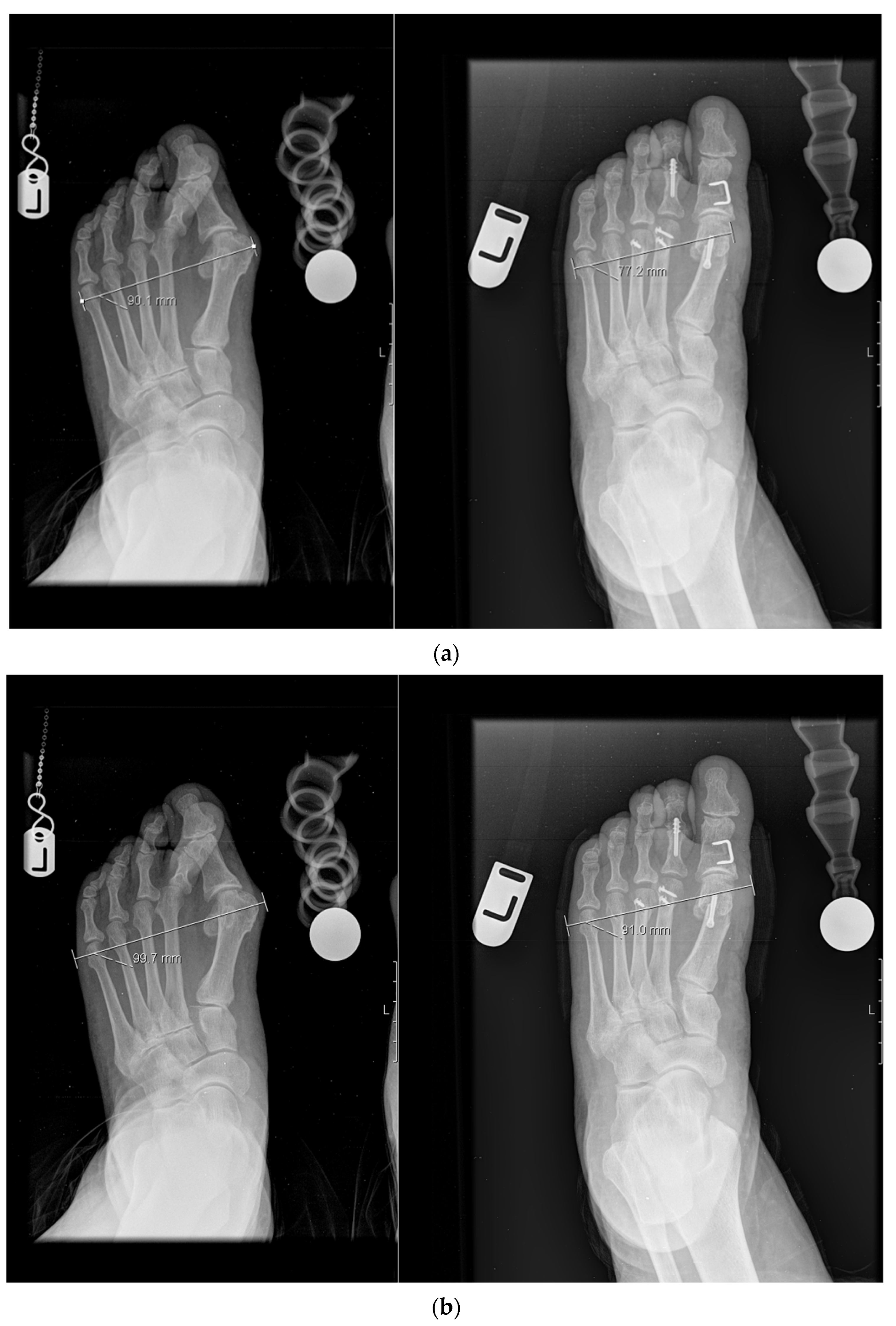 Hallux Varus Repair