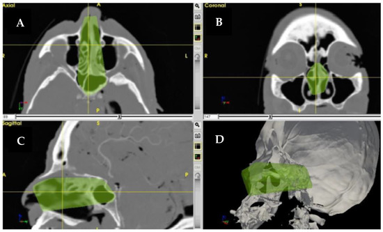 Skull-Base Surgery—A Narrative Review on Current Approaches