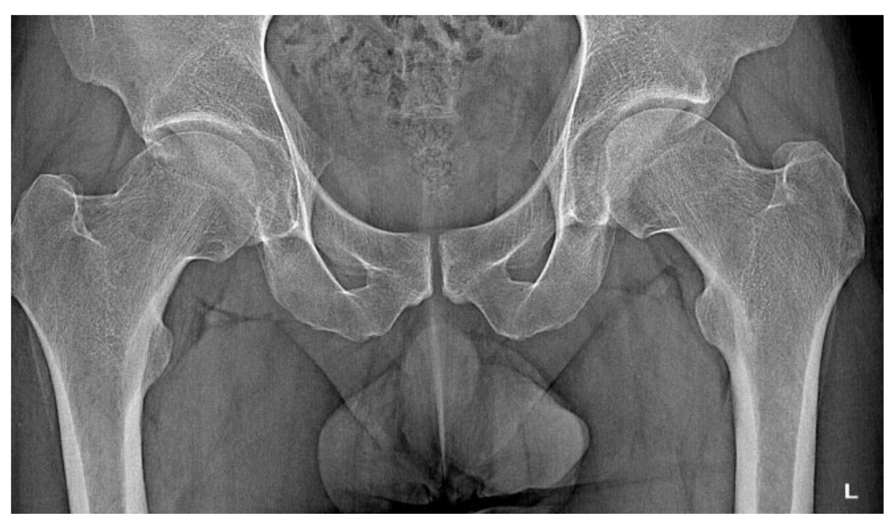 JCM Free Full-Text Osteoid Osteoma, a Diagnostic Problem A Series of Atypical and Mimicking Presentations and Review of the Recent Literature image
