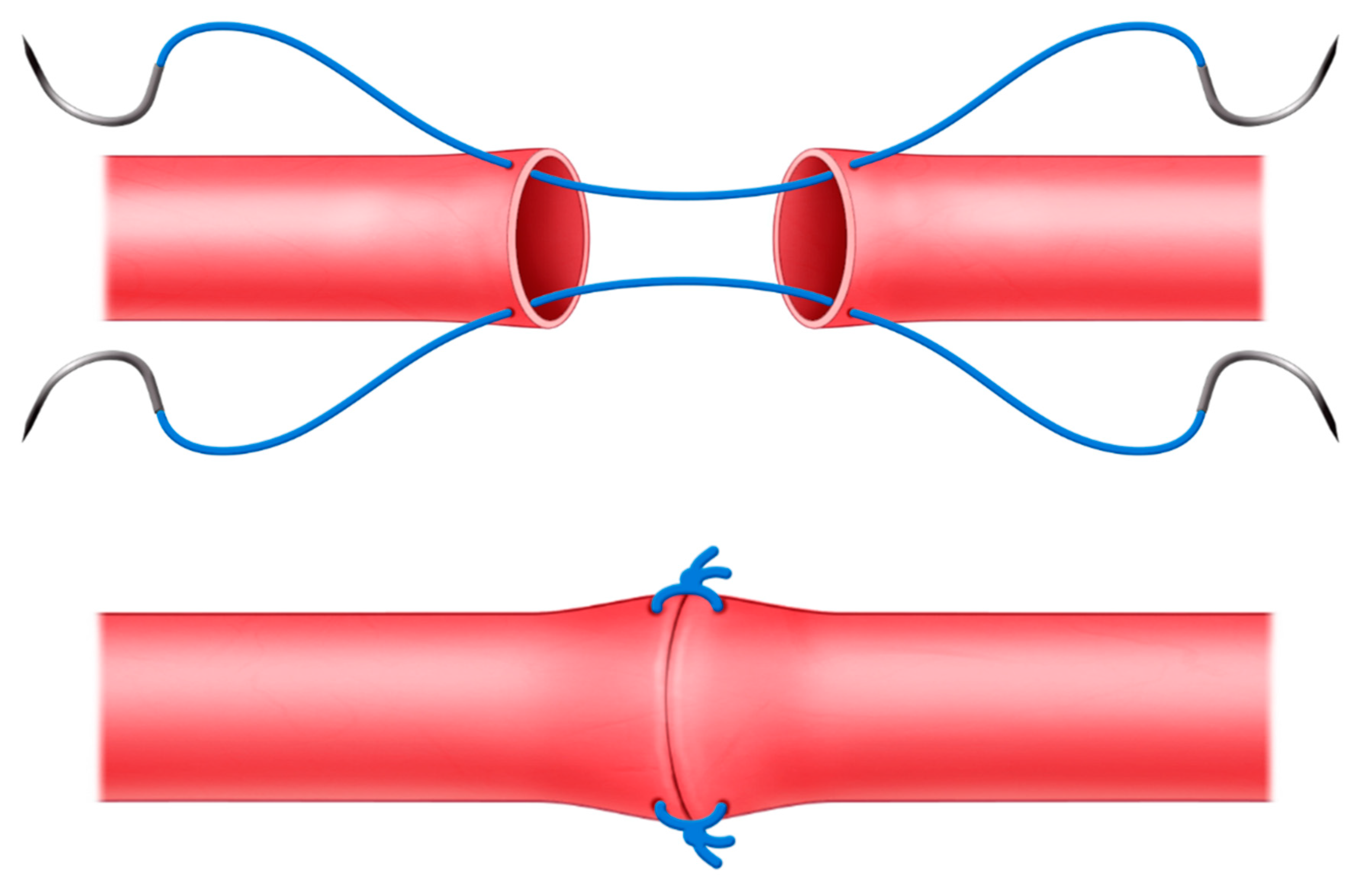 JCM Free FullText What Is the Minimum Number of Sutures for Microvascular Anastomosis