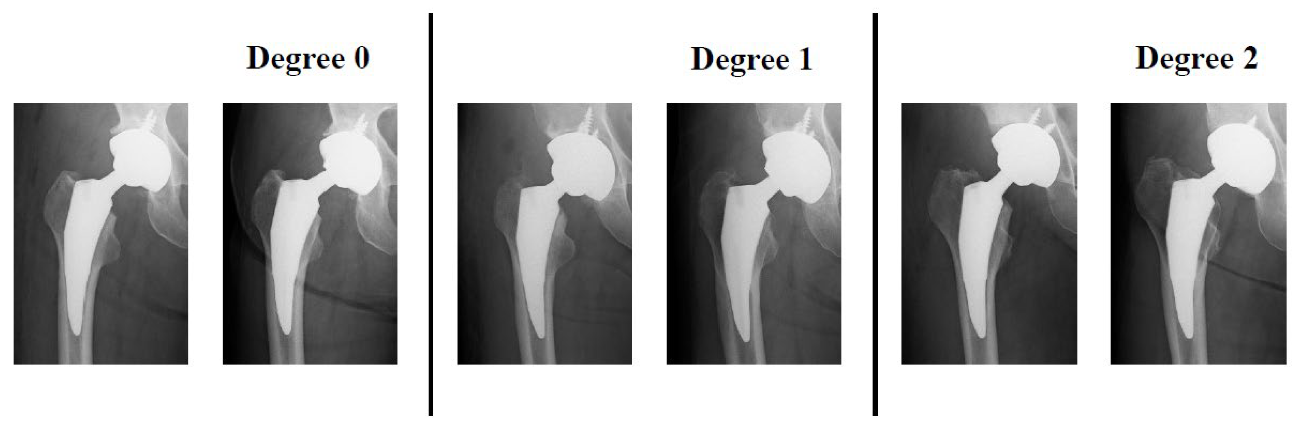 JCM Free FullText Relationship between Stress Shielding and