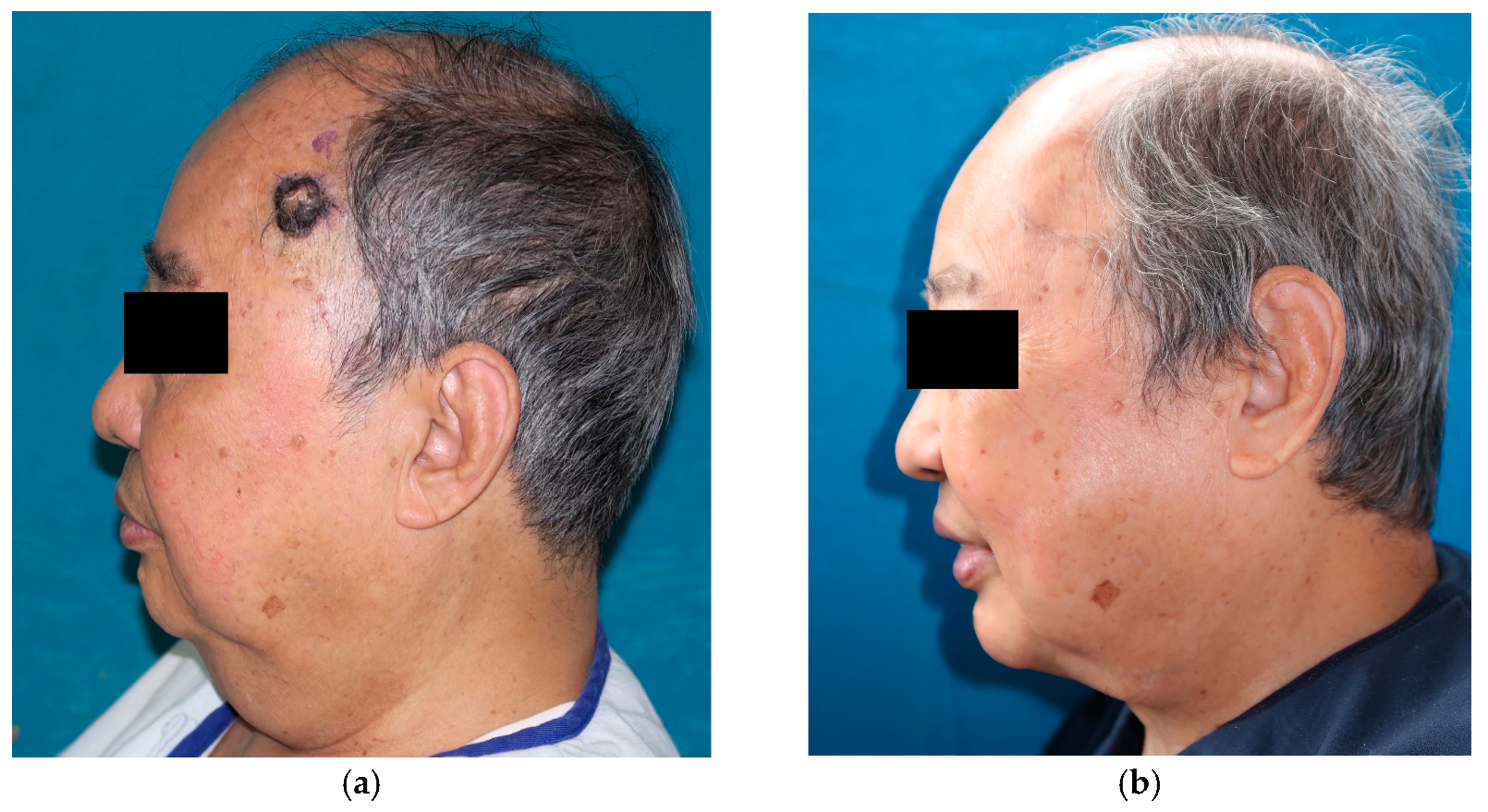 JCM Free FullText FullThickness Skin Graft from the Submental