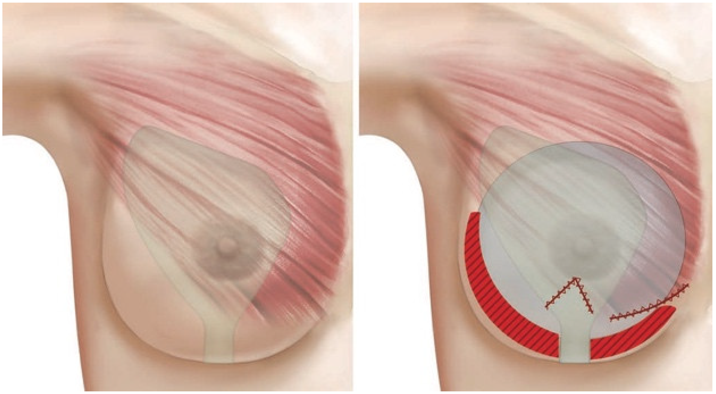 Dr. Alexander & Co. - Breast augmentation done with silicone gel