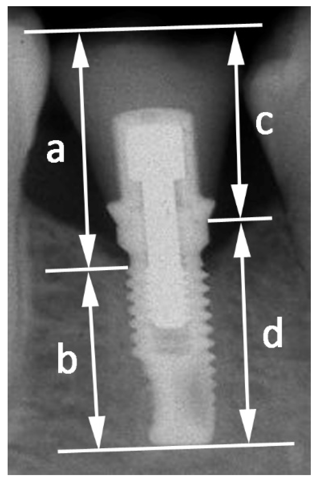 JCM Free FullText Influence of CrownImplant Ratio and Implant