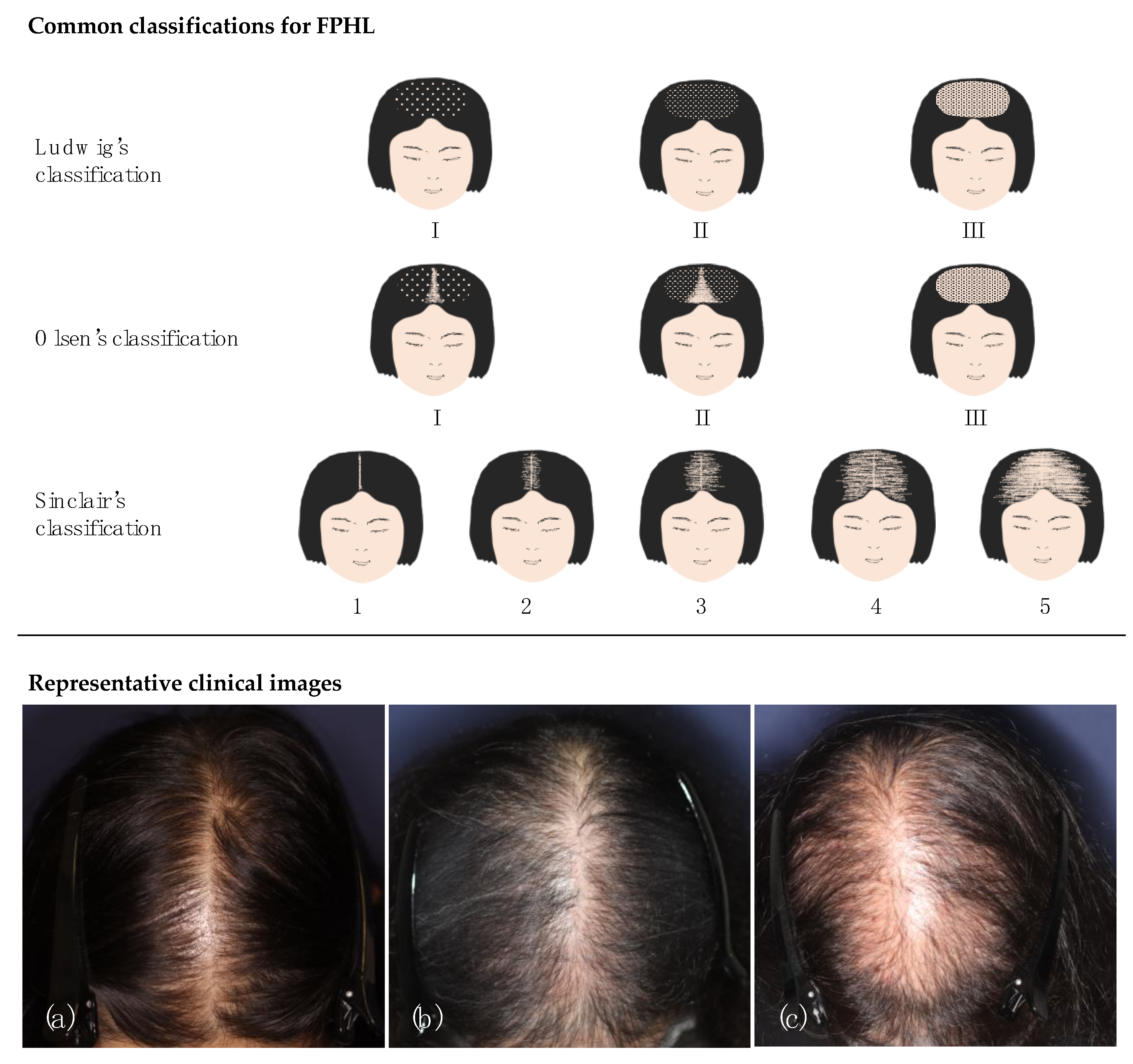 Ludwig's Scale for Women - Use Ludwigs Scale Chart For Hair Loss