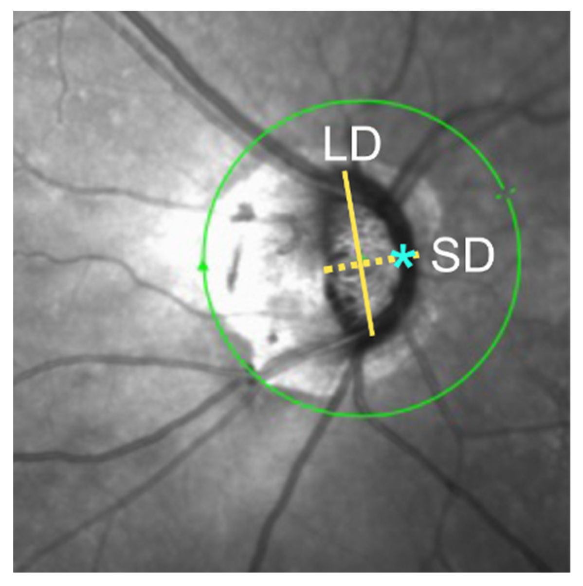 JCM Free FullText Optic Disc Morphology and Paracentral Scotoma in