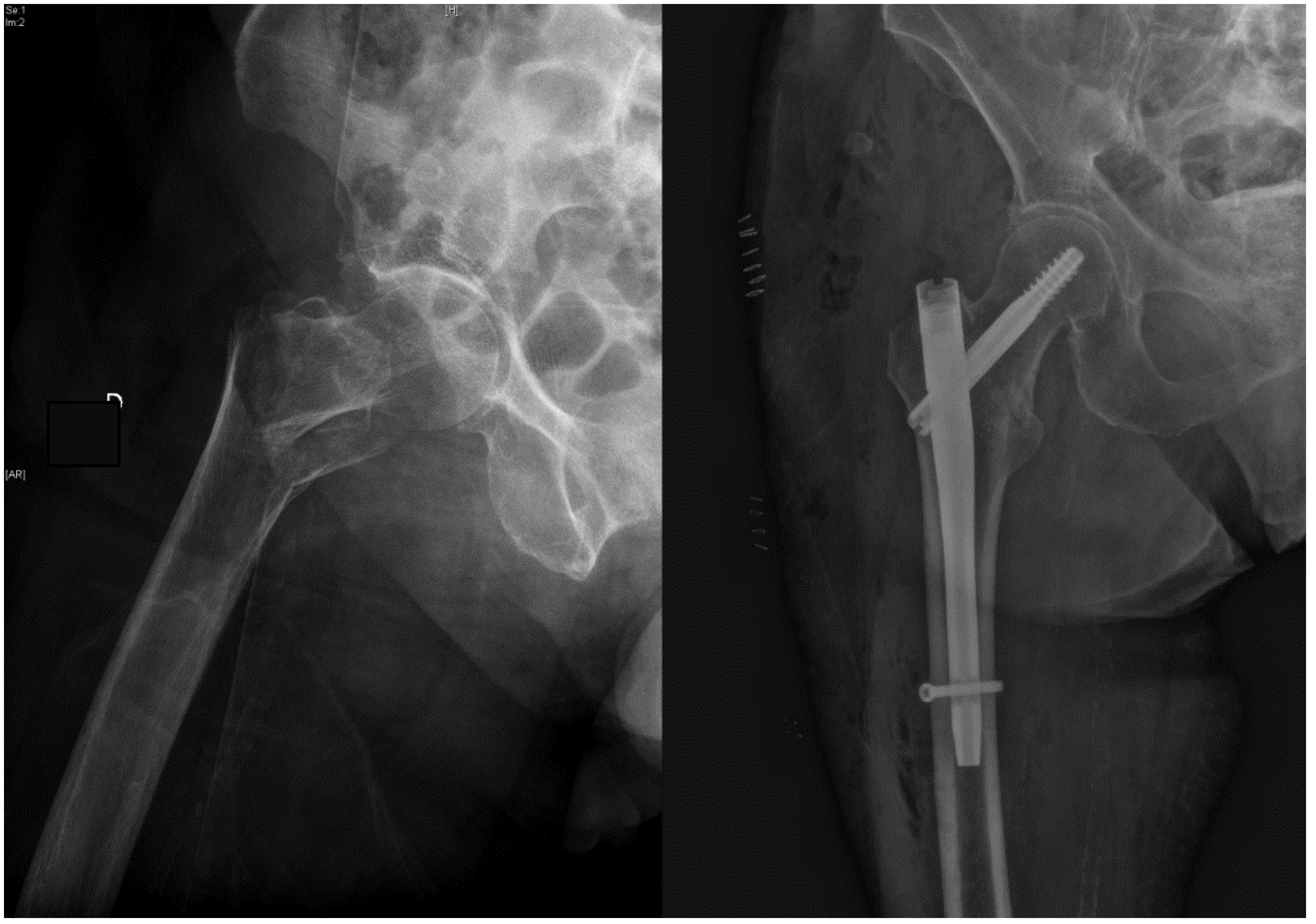 Does the implant make the difference   Prospective comparison of two  different proximal femur nails