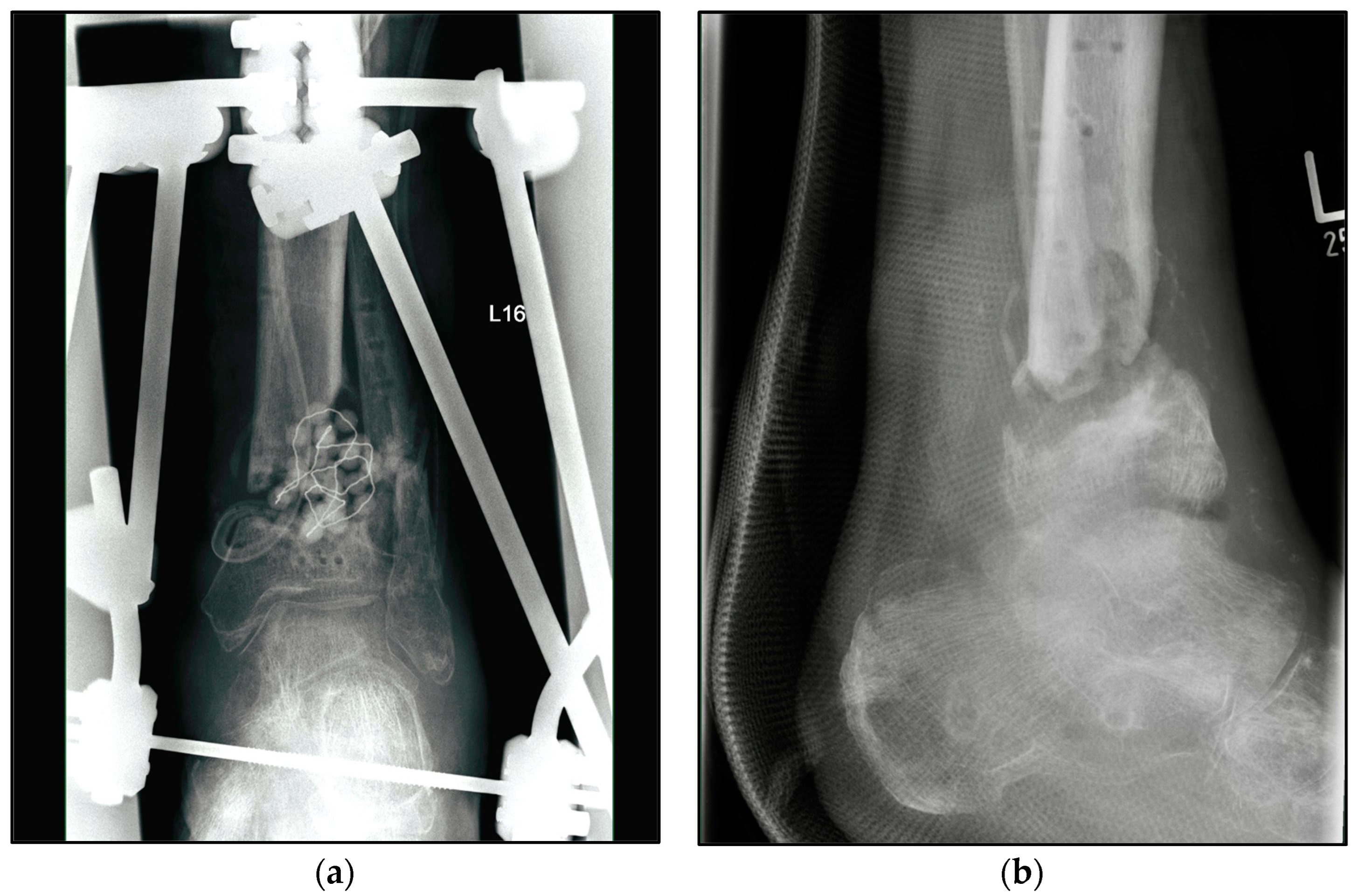 Analysis of bone transport for ankle arthrodesis as a limb salvage  procedure for the treatment of septic pilon fracture nonunion