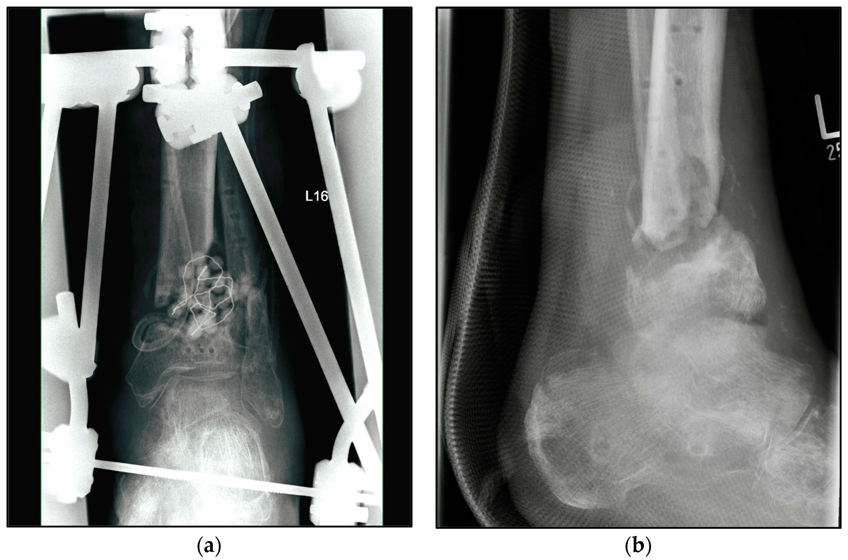 Wholesale Tibia Fixator, Wholesale Tibia Fixator Manufacturers