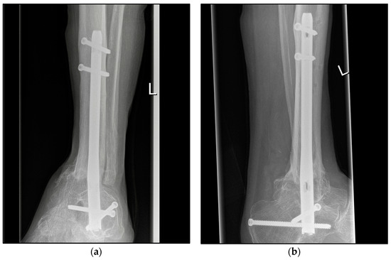 Analysis of bone transport for ankle arthrodesis as a limb salvage  procedure for the treatment of septic pilon fracture nonunion