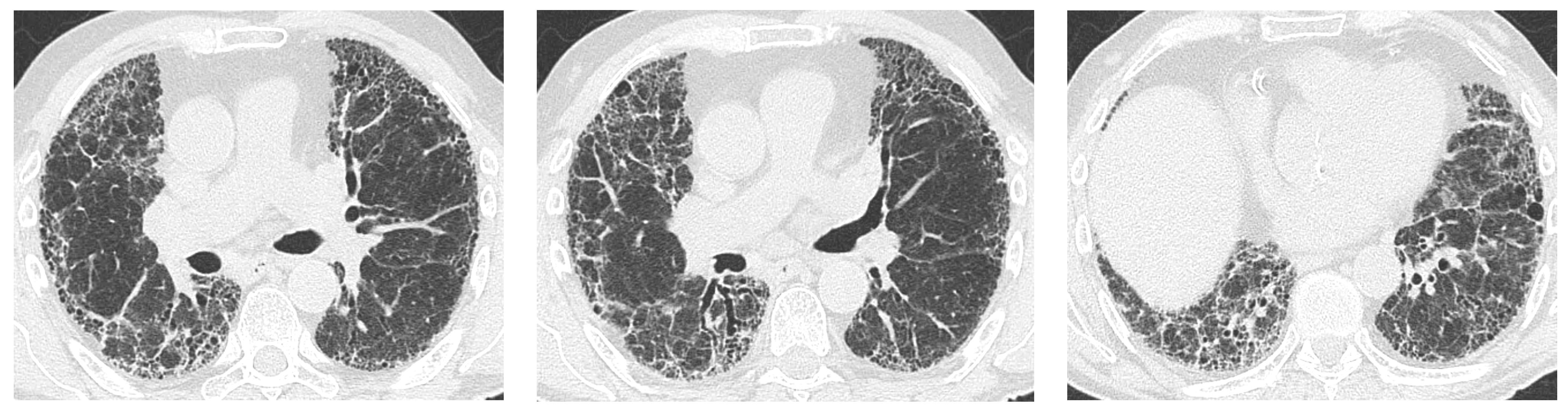 JCM Free Full-Text Primary-Sjandouml;grenandrsquo;s-Syndrome-Related Interstitial Lung Disease A Clinical Review Discussing Current Controversies picture