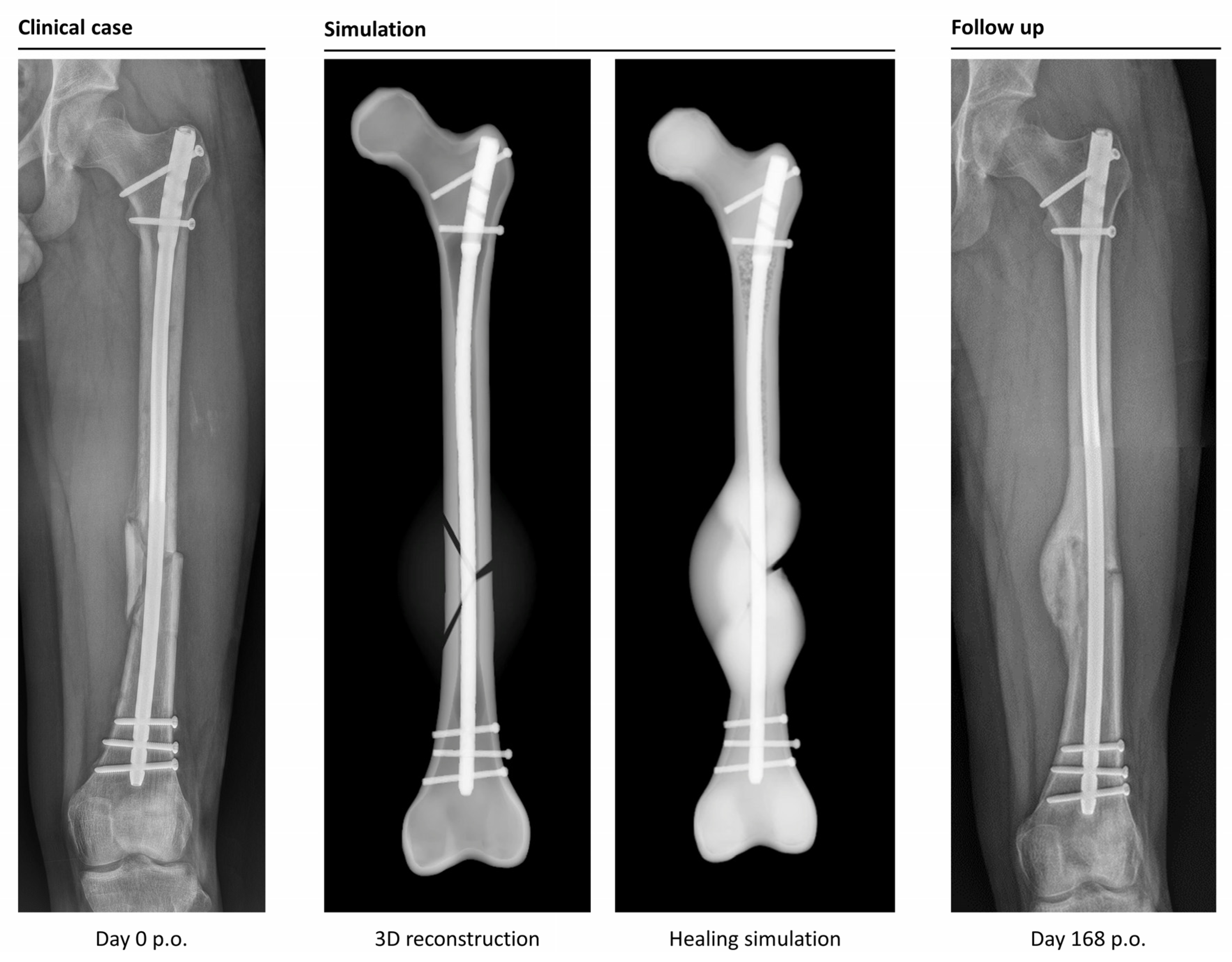 Femur fracture